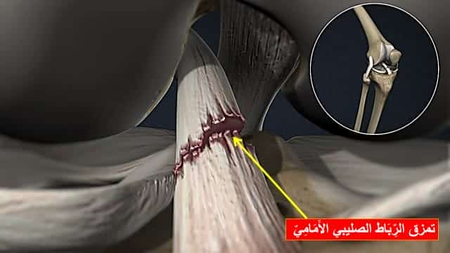 تكلفة الرباط الصليبي الأمامي