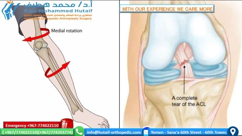 acl symptom