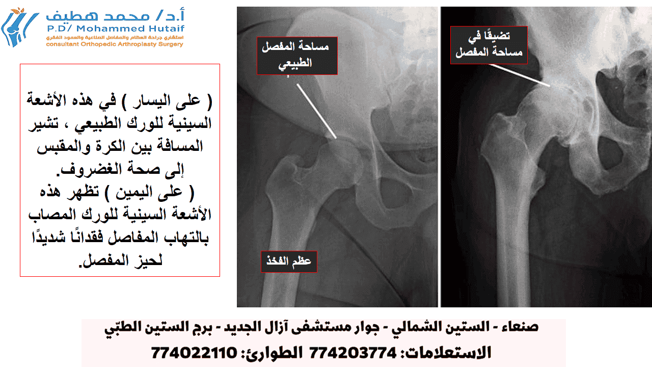 هل جراحة استبدال مفصل الورك مناسبة لك؟ يجب أن يكون قرار إجراء جراحة استبدال مفصل الورك قرارًا تعاونيًا تتخذه أنت وعائلتك وطبيب الرعاية الأولية وجراح العظام. تبدأ عملية اتخاذ هذا القرار عادةً بإحالة ا.د محمد هطيف   إلى جراح العظام لإجراء تقييم أولي.  عندما ينصح بالجراحة هناك عدة أسباب قد تجعل ا.د محمد هطيف   يوصي بإجراء جراحة استبدال مفصل الورك. غالبًا ما يعاني الأشخاص الذين يستفيدون من جراحة استبدال مفصل الورك من:  •	ألم الورك الذي يحد من الأنشطة اليومية ، مثل المشي أو الانحناء •	ألم الورك الذي يستمر أثناء الراحة ، ليلاً أو نهارًا •	تصلب في الورك يحد من القدرة على تحريك أو رفع الساق •	تخفيف الآلام غير الكافي من الأدوية المضادة للالتهابات أو العلاج الطبيعي أو دعامات المشي المرشحون للجراحة لا توجد قيود مطلقة للعمر أو الوزن لاستبدال مفصل الورك.  تستند توصيات الجراحة إلى ألم المريض وإعاقته، وليس العمر. معظم المرضى الذين خضعوا لاستبدال مفصل الورك تتراوح أعمارهم بين 50 و 80 عامًا، لكن جراحي العظام يقومون بتقييم المرضى بشكل فردي. تم إجراء عمليات استبدال مفصل الورك بالكامل بنجاح في جميع الأعمار ، من المراهق الشاب المصاب بالتهاب المفاصل عند الأطفال إلى المريض المسن المصاب بالتهاب المفاصل التنكسي.  تقييم العظام يتكون التقييم مع جراح العظام من عدة مكونات:  تاريخ طبى.  سيجمع جراح العظام معلومات عن صحتك العامة ويطرح أسئلة حول مدى ألم الورك وكيف يؤثر على قدرتك على أداء الأنشطة اليومية. الفحص البدني. سيقيم هذا حركة الورك والقوة والمحاذاة. الأشعة السينية. تساعد هذه الصور في تحديد مدى الضرر أو التشوه في الورك. اختبارات أخرى. من حين لآخر ، قد تكون هناك حاجة لاختبارات أخرى ، مثل التصوير بالرنين المغناطيسي (MRI) لتحديد حالة العظام والأنسجة الرخوة في الورك. الأشعة السينية للورك الطبيعي والورك مع التهاب المفاصل (على اليسار) في هذه الأشعة السينية للورك الطبيعي ، تشير المسافة بين الكرة والمقبس إلى صحة الغضروف. (على اليمين) تظهر هذه الأشعة السينية للورك المصاب بالتهاب المفاصل فقدانًا شديدًا لحيز المفصل.