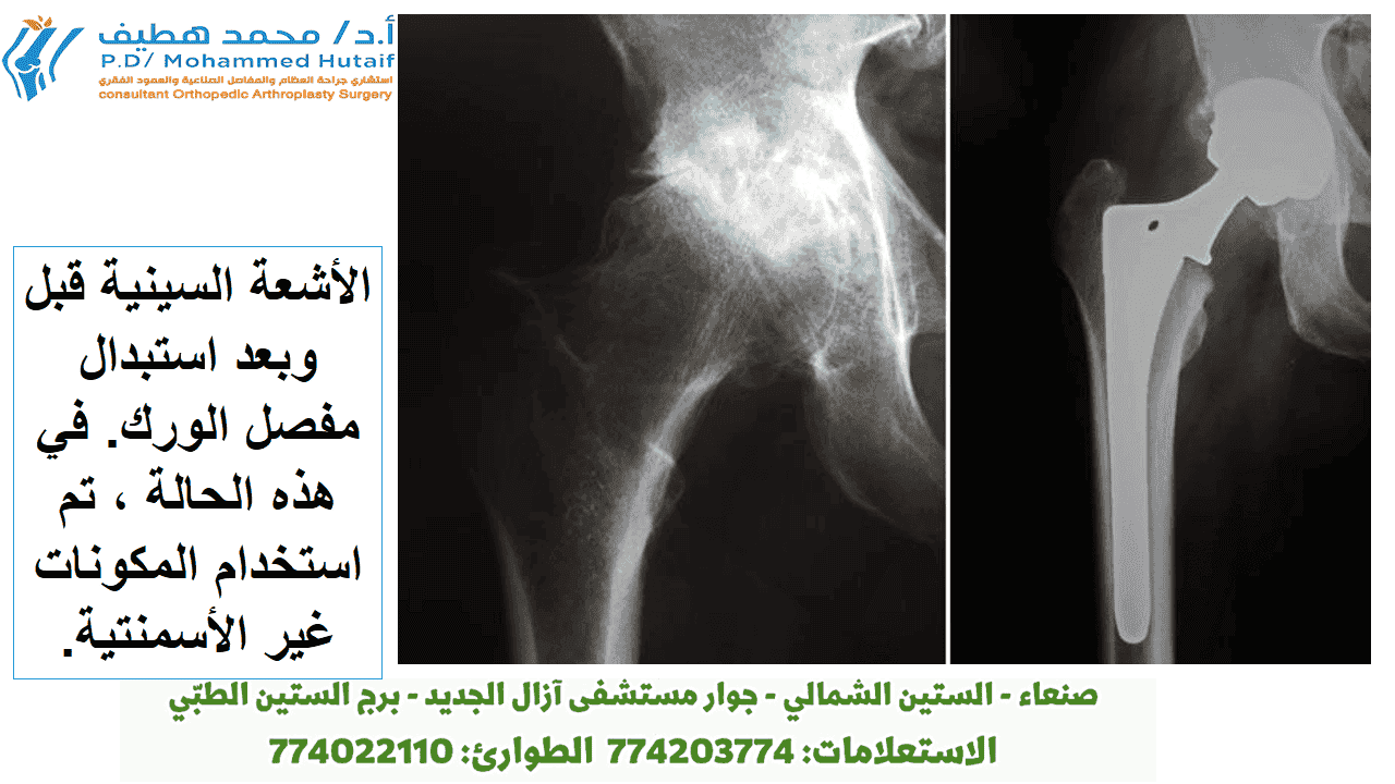 إجراء تستغرق العملية الجراحية عادة من ساعة إلى ساعتين. سيقوم جراح العظام الخاص بك بإزالة الغضروف والعظام التالفين ثم وضع غرسات معدنية أو بلاستيكية أو خزفية جديدة لاستعادة محاذاة ووظيفة الورك.  الأشعة السينية قبل وبعد استبدال مفصل الورك. الأشعة السينية قبل وبعد استبدال مفصل الورك. في هذه الحالة ، تم استخدام المكونات غير الأسمنتية.  بعد الجراحة ، سيتم نقلك إلى غرفة الإنعاش حيث ستبقى لعدة ساعات بينما تتم متابعة تعافيك من التخدير. بعد أن تستيقظ ، سيتم اصطحابك إلى غرفتك بالمستشفى أو خروجك إلى المنزل.  استعادة يعتمد نجاح الجراحة إلى حد كبير على مدى اتباعك لتعليمات جراح العظام فيما يتعلق بالرعاية المنزلية خلال الأسابيع القليلة الأولى بعد الجراحة.  إدارة الألم غالبًا ما توصف الأدوية لتخفيف الآلام على المدى القصير بعد الجراحة. تتوفر العديد من أنواع الأدوية للمساعدة في إدارة الألم ، بما في ذلك المواد الأفيونية والأدوية غير الستيرويدية المضادة للالتهابات (NSAIDs) والأسيتامينوفين والمخدرات الموضعية. قد يستخدم ا.د محمد هطيف   مجموعة من هذه الأدوية لتحسين تخفيف الألم ، وكذلك تقليل الحاجة إلى المواد الأفيونية.  اعلم أنه على الرغم من أن المواد الأفيونية تساعد في تخفيف الألم بعد الجراحة ، إلا أنها مخدرة ويمكن أن تسبب الإدمان. أصبح الاعتماد على المواد الأفيونية والجرعة الزائدة من المشكلات الصحية العامة الحرجة في الولايات المتحدة. من المهم استخدام المواد الأفيونية فقط وفقًا لتوجيهات الطبيب. بمجرد أن يبدأ الألم في التحسن ، توقف عن تناول المواد الأفيونية. تحدث إلى ا.د محمد هطيف   إذا لم يبدأ الألم في التحسن في غضون أيام قليلة من الجراحة.  العناية بالجروح قد يكون لديك غرز أو دبابيس تعمل على طول الجرح أو خياطة تحت الجلد. ستتم إزالة الغرز أو الدبابيس بعد أسبوعين تقريبًا من الجراحة.  تجنب تبلل الجرح حتى يغلق تمامًا ويجف. يمكنك الاستمرار في تضميد الجرح لمنع تهيج الملابس أو الجوارب الداعمة.  حمية فقدان الشهية أمر شائع لعدة أسابيع بعد الجراحة. النظام الغذائي المتوازن ، غالبًا مع مكمل الحديد ، مهم لتعزيز التئام الأنسجة السليم واستعادة قوة العضلات. تأكد من شرب الكثير من السوائل.  نشاط التمرين عنصر حاسم في الرعاية المنزلية ، خاصة خلال الأسابيع القليلة الأولى بعد الجراحة. يجب أن تكون قادرًا على استئناف معظم الأنشطة الخفيفة العادية للحياة اليومية في غضون 3 إلى 6 أسابيع بعد الجراحة. بعض الانزعاج من النشاط والليل شائع لعدة أسابيع.  يجب أن يتضمن برنامج نشاطك ما يلي:  برنامج مشي متدرج لزيادة قدرتك على الحركة ببطء ، في البداية في منزلك ثم في الخارج لاحقًا استئناف الأنشطة المنزلية العادية الأخرى ، مثل الجلوس والوقوف وصعود السلالم تمارين محددة عدة مرات في اليوم لاستعادة الحركة وتقوية الورك. من المحتمل أن تكون قادرًا على أداء التمارين دون مساعدة ، ولكن قد يكون لديك معالج فيزيائي يساعدك في المنزل أو في مركز العلاج في الأسابيع القليلة الأولى بعد الجراحة العلاج الطبيعي لاستبدال مفصل الورك سيساعد العلاج الطبيعي في استعادة القوة والقدرة على الحركة في الورك ،