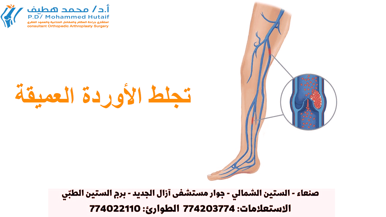 لطات الدم تعد الجلطات الدموية في أوردة الساق أو الحوض من أكثر مضاعفات جراحة استبدال مفصل الورك شيوعًا. يمكن أن تكون هذه الجلطات مهددة للحياة إذا تحررت وانتقلت إلى رئتيك. سيحدد جراح العظام برنامجًا وقائيًا قد يشمل أدوية ترقق الدم ، وخرطوم الدعم ، وأغطية الساق القابلة للنفخ ، وتمارين مضخة الكاحل ، والتعبئة المبكرة.    تجلط الأوردة العميقة قد تتكون جلطات الدم في أحد الأوردة العميقة في الجسم.  بينما يمكن أن تحدث جلطات الدم في أي وريد عميق ، إلا أنها تتشكل بشكل شائع في أوردة الحوض أو ربلة الساق أو الفخذ.