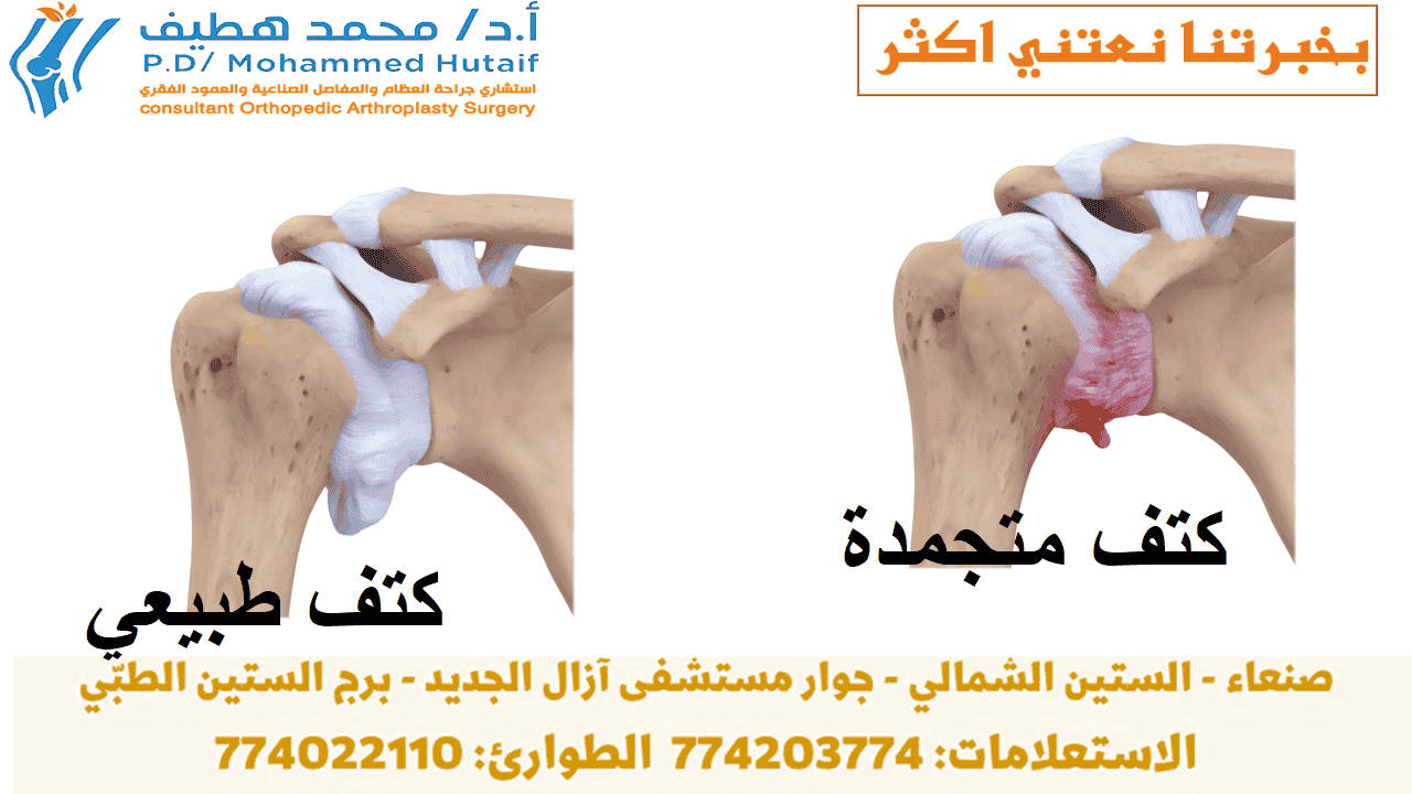  الكتف المتجمد  ملخص الكتف المتجمد ، ويسمى أيضًا التهاب المحفظة اللاصق ، يسبب ألمًا وتيبسًا في الكتف. بمرور الوقت ، يصبح من الصعب جدًا تحريك الكتف.  بعد فترة من تفاقم الأعراض ، يميل الكتف المتجمد إلى التحسن ، على الرغم من أن الشفاء التام قد يستغرق ما يصل إلى 3 سنوات. العلاج الطبيعي ، مع التركيز على مرونة الكتف ، هو العلاج الأساسي للكتف المتجمدة.  يصيب الكتف المتجمد بشكل شائع الأشخاص الذين تتراوح أعمارهم بين 40 و 60 عامًا ، ويحدث عند النساء أكثر من الرجال. بالإضافة إلى ذلك ، يتعرض مرضى السكري لخطر الإصابة بتجمد الكتف.  تزداد خطورة الإصابة بالكتف المتجمدة ما إذا كنت تتماثل للشفاء من إجراء أو حالة طبية تمنعك من تحريك ذراعك، كالسكتة الدماغية أو استئصال الثدي. الوسائط ذات الصلة تمارين تأهيل الكفة والكتف يتضمن علاج الكتف المتجمدة تمارين مدى الحركة وأحيانًا ما يتضمن الكورتيكوستيرويدات وأدوية مخدرة يتم حقنها بالمحفظة المفصلية. في نسبة صغيرة من الحالات يمكن الإشارة إلى جراحة تنظير المفصل لإرخاء المحفظة المفصلية حتى تتمكن من الحركة بحرية أكبر.  من غير الطبيعي معاودة الإصابة بالكتف المتجمدة في نفس الكتف، ولكن يمكن إصابة بعض الأشخاص في الكتف الأخرى. في هذه النشرة الكتف المتجمد- ملخص الصفحة التالية: تشريح الكتف تشريح كتفك عبارة عن مفصل كروي ومقبس يتكون من ثلاثة عظام: عظم الذراع العلوي (عظم العضد) وكتفك (الكتف) وعظم الترقوة (الترقوة).  يتناسب رأس عظم العضد مع تجويف ضحل في لوح الكتف. نسيج ضام قوي ، يسمى كبسولة الكتف ، يحيط بالمفصل.  لمساعدة كتفك على التحرك بسهولة أكبر ، يقوم السائل الزليلي بتشحيم كبسولة الكتف والمفصل.  تشريح الكتف تحيط كبسولة الكتف بمفصل الكتف وأوتار الكفة المدورة. مستنسخة ومعدلة من تقويم الجسم. (ج) الأكاديمية الأمريكية لجراحي العظام ، 2003. وصف في الكتف المتجمد ، تزداد سماكة كبسولة الكتف وتصبح صلبة ومشدودة. تتطور عصابات سميكة من الأنسجة - تسمى التصاقات. في كثير من الحالات ، يوجد سائل زليلي أقل في المفصل.  العلامات المميزة لهذه الحالة هي الألم الشديد وعدم القدرة على تحريك كتفك - إما بمفردك أو بمساعدة شخص آخر. يتطور على ثلاث مراحل:  المرحلة 1: التجميد في مرحلة 