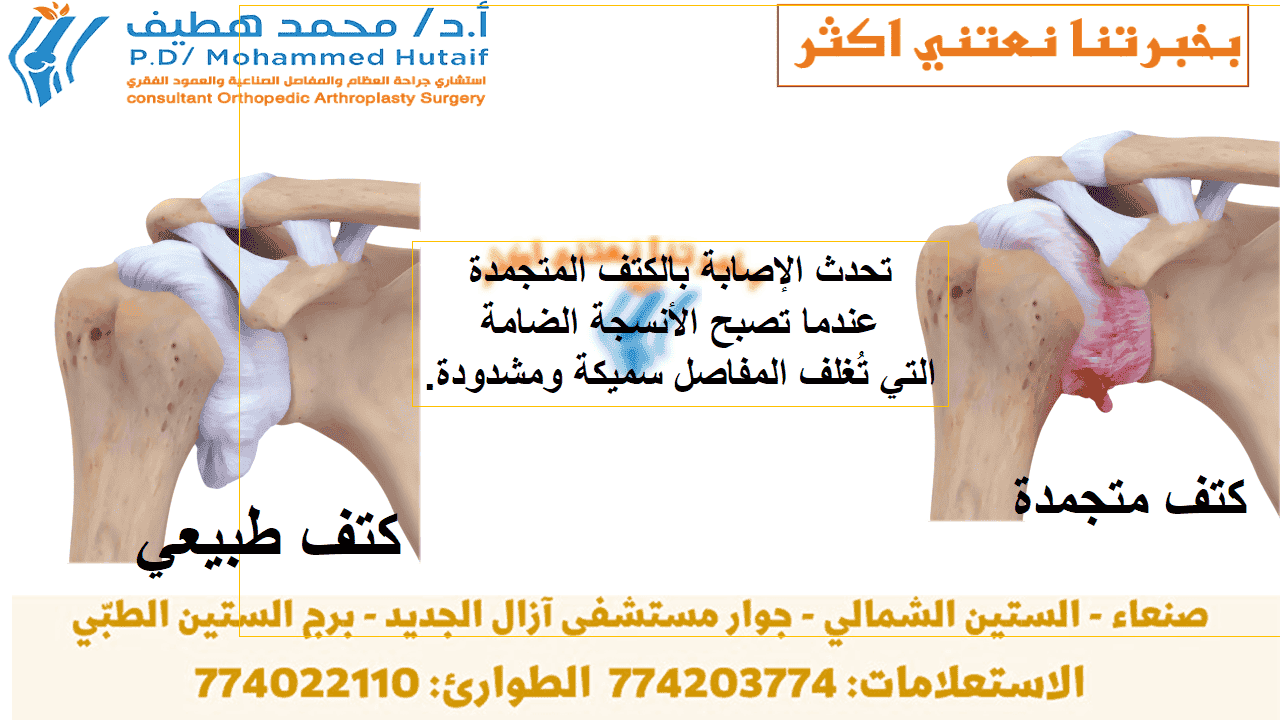  الكتف المتجمد  ملخص الكتف المتجمد ، ويسمى أيضًا التهاب المحفظة اللاصق ، يسبب ألمًا وتيبسًا في الكتف. بمرور الوقت ، يصبح من الصعب جدًا تحريك الكتف.  بعد فترة من تفاقم الأعراض ، يميل الكتف المتجمد إلى التحسن ، على الرغم من أن الشفاء التام قد يستغرق ما يصل إلى 3 سنوات. العلاج الطبيعي ، مع التركيز على مرونة الكتف ، هو العلاج الأساسي للكتف المتجمدة.  يصيب الكتف المتجمد بشكل شائع الأشخاص الذين تتراوح أعمارهم بين 40 و 60 عامًا ، ويحدث عند النساء أكثر من الرجال. بالإضافة إلى ذلك ، يتعرض مرضى السكري لخطر الإصابة بتجمد الكتف.  تزداد خطورة الإصابة بالكتف المتجمدة ما إذا كنت تتماثل للشفاء من إجراء أو حالة طبية تمنعك من تحريك ذراعك، كالسكتة الدماغية أو استئصال الثدي. الوسائط ذات الصلة تمارين تأهيل الكفة والكتف يتضمن علاج الكتف المتجمدة تمارين مدى الحركة وأحيانًا ما يتضمن الكورتيكوستيرويدات وأدوية مخدرة يتم حقنها بالمحفظة المفصلية. في نسبة صغيرة من الحالات يمكن الإشارة إلى جراحة تنظير المفصل لإرخاء المحفظة المفصلية حتى تتمكن من الحركة بحرية أكبر.  من غير الطبيعي معاودة الإصابة بالكتف المتجمدة في نفس الكتف، ولكن يمكن إصابة بعض الأشخاص في الكتف الأخرى. في هذه النشرة الكتف المتجمد- ملخص الصفحة التالية: تشريح الكتف تشريح -الكتف المتجمد كتفك عبارة عن مفصل كروي ومقبس يتكون من ثلاثة عظام: عظم الذراع العلوي (عظم العضد) وكتفك (اللوح) وعظم الترقوة   يتناسب رأس عظم العضد مع تجويف ضحل في لوح الكتف. هناك نسيج ضام قوي ، يسمى كبسولة الكتف ، يحيط بالمفصل. في هذه النشرة الكتف المتجمد- ملخص تشريح -الكتف المتجمد وصف الكتف المتجمد لمساعدة كتفك على التحرك بسهولة أكبر ، يقوم السائل الزليلي بتشحيم كبسولة الكتف والمفصل.  تشريح الكتف تحيط كبسولة الكتف بمفصل الكتف وأوتار الكفة المدورة. تحدث الإصابة بالكتف المتجمدة عندما تصبح الأنسجة الضامة التي تُغلف المفاصل سميكة ومشدودة.  الوسائط ذات الصلة تمارين تأهيل الكفة والكتف  الصفحة التالية: وصف الكتف المتجمد  وصف في الكتف المتجمد ، تزداد سماكة كبسولة الكتف وتصبح صلبة ومشدودة. تتطور عصابات سميكة من الأنسجة - تسمى التصاقات. في كثير من الحالات ، يوجد سائل زليلي أقل في المفصل.  العلامات المميزة لهذه الحالة هي الألم الشديد وعدم القدرة على تحريك كتفك - إما بمفردك أو بمساعدة شخص آخر. يتطور على ثلاث مراحل:  المرحلة 1: التجميد في مرحلة "التجميد" ، تشعر ببطء أكثر فأكثر. مع تفاقم الألم ، يفقد كتفك نطاق حركته. يستمر التجميد عادةً من 6 أسابيع إلى 9 أشهر.  المرحلة الثانية: مجمدة قد تتحسن الأعراض المؤلمة بالفعل خلال هذه المرحلة ، لكن التيبس لا تزال قائمة. خلال 4 إلى 6 أشهر من مرحلة "التجميد" ، قد تكون الأنشطة اليومية صعبة للغاية.  المرحلة الثالثة: الذوبان تتحسن حركة الكتف ببطء خلال مرحلة "الذوبان". عادةً ما تستغرق العودة الكاملة إلى الوضع الطبيعي أو قريبًا من القوة الطبيعية والحركة من 6 أشهر إلى سنتين.  كبسولة مفصلية ملتهبة في الكتف المتجمد ، تصبح الأنسجة الملساء لكبسولة الكتف سميكة وصلبة وملتهبة.  سبب أسباب الكتف المتجمد ليست مفهومة تماما. لا توجد علاقة واضحة بهيمنة السلاح أو الاحتلال. قد تعرضك بعض العوامل لخطر الإصابة بتجمد الكتف.  داء السكري. يحدث الكتف المتجمد في كثير من الأحيان عند مرضى السكري. السبب لهذا الشيئ ير معلوم. بالإضافة إلى ذلك ، يميل مرضى السكري الذين يعانون من تجمد الكتف إلى درجة أكبر من الصلابة تستمر لفترة أطول قبل "الذوبان".  أمراض أخرى. تشمل بعض المشكلات الطبية الإضافية المرتبطة بتجمد الكتف قصور الغدة الدرقية وفرط نشاط الغدة الدرقية ومرض باركنسون وأمراض القلب.  الشلل. يمكن أن يتطور الكتف المتجمد بعد تثبيت الكتف لفترة من الوقت بسبب الجراحة أو الكسر أو إصابة أخرى. إن جعل المرضى يحركون أكتافهم بعد الإصابة أو الجراحة بفترة وجيزة هو أحد الإجراءات الموصوفة لمنع الكتف المتجمد.  أعراض عادة ما يكون الألم من الكتف المتجمدة خفيفًا أو مؤلمًا. عادة ما يكون أسوأ في وقت مبكر من مسار المرض وعندما تحرك ذراعك. يقع الألم عادة فوق منطقة الكتف الخارجية وأحيانًا أعلى الذراع.  فحص الطبيب الفحص البدني بعد مناقشة الأعراض والتاريخ الطبي ، سيفحص طبيبك كتفك.  سيحرك طبيبك كتفك بعناية في جميع الاتجاهات ليرى ما إذا كانت الحركة محدودة وما إذا كان الألم يحدث مع الحركة. نطاق الحركة عندما يحرك شخص آخر كتفك يسمى "نطاق الحركة السلبي". سيقارن طبيبك هذا بنطاق الحركة الذي تعرضه عندما تحرك كتفك بمفردك ("النطاق النشط للحركة"). الأشخاص الذين يعانون من الكتف المتجمد لديهم نطاق محدود من الحركة سواء بشكل نشط أو سلبي.  الفحص البدني للكتف المتجمدة سيختبر طبيبك نطاق الحركة في كتفك. مستنسخ من JF Sarwark، ed: Essentials of Musculoskeletal Care، ed 4. Rosemont، IL، American Academy of Orthopedic Surgeons، 2010 اختبارات التصوير تشمل الاختبارات الأخرى التي قد تساعد طبيبك في استبعاد الأسباب الأخرى للتصلب والألم ما يلي:  الأشعة السينية. تظهر الهياكل الكثيفة ، مثل العظام ، بوضوح في الأشعة السينية. قد تظهر الأشعة السينية مشاكل أخرى في كتفك ، مثل التهاب المفاصل.  التصوير بالرنين المغناطيسي (MRI) والموجات فوق الصوتية. يمكن أن تخلق هذه الدراسات صورًا أفضل للأنسجة الرخوة. لا يُطلب منهم تشخيص الكتف المتجمد ، ومع ذلك ، فقد يساعدون في تحديد مشاكل أخرى في كتفك ، مثل الكفة المدورة الممزقة.  مقالات ذات صلة  ما هي مضادات الالتهاب غير الستيروئيدية؟  تنظير مفصل الكتف  الكالسيوم والتغذية وصحة العظام  علاج او معاملة يتحسن الكتف المتجمد بشكل عام بمرور الوقت ، على الرغم من أنه قد يستغرق ما يصل إلى 3 سنوات. ينصب تركيز العلاج على السيطرة على الألم واستعادة الحركة والقوة من خلال العلاج الطبيعي.  العلاج غير الجراحي يتحسن معظم المصابين بالكتف المتجمدة بعلاجات بسيطة نسبيًا للسيطرة على الألم واستعادة الحركة.  الأدوية المضادة للالتهابات غير الستيرويدية. الأدوية مثل الأسبرين والأيبوبروفين تقلل الألم والتورم.  حقن الستيرويد. الكورتيزون هو دواء قوي مضاد للالتهابات يتم حقنه مباشرة في مفصل الكتف.  التوسيع المائي. إذا لم يتم تخفيف الأعراض عن طريق طرق غير جراحية أخرى ، فقد يوصي طبيبك بالتوسع المائي. يتضمن هذا الإجراء حقن كمية كبيرة من السائل المعقم برفق في مفصل الكتف لتوسيع وتمديد كبسولة مفصل الكتف. يتم إجراء التوسيع المائي بواسطة أخصائي الأشعة الذي يستخدم التصوير لتوجيه وضع السوائل.   علاج بدني. ستساعد تمارين محددة على استعادة الحركة. يمكن القيام بذلك تحت إشراف معالج طبيعي أو عن طريق برنامج منزلي. يشمل العلاج شد الكتف أو مجموعة من تمارين الحركة. تستخدم الحرارة أحيانًا للمساعدة في إرخاء الكتف قبل التمدد. فيما يلي أمثلة لبعض التمارين التي قد يوصى بها.  الدوران الخارجي - التمدد السلبي. قف في المدخل وقم بثني كوع ذراعك المصاب إلى 90 درجة للوصول إلى عضادة الباب. ضع يدك في مكانها وقم بتدوير جسمك كما هو موضح في الرسم التوضيحي. استمر لمدة 30 ثانية. استرخ وكرر. الدوران الخارجي - التمدد السلبي الدوران الخارجي - التمدد السلبي مستنسخ ومعدّل من JF Sarwark ، محرر: أساسيات العناية العضلية الهيكلية ، الطبعة 4. Rosemont ، IL ، الأكاديمية الأمريكية لجراحي العظام ، 2010. انثناء إلى الأمام - وضع ضعيف. استلق على ظهرك مع استقامة ساقيك. استخدم ذراعك السليمة لرفع ذراعك المصابة فوق رأسك حتى تشعر بتمدد خفيف. استمر لمدة 15 ثانية وانخفض ببطء لبدء الوضع. استرخ وكرر. ثني إلى الأمام - وضع ضعيف ثني إلى الأمام - وضع ضعيف مستنسخ ومعدّل من JF Sarwark ، محرر: أساسيات العناية العضلية الهيكلية ، الطبعة 4. Rosemont ، IL ، الأكاديمية الأمريكية لجراحي العظام ، 2010. تمتد ذراع كروس. اسحب إحدى ذراعيك برفق عبر صدرك أسفل ذقنك قدر الإمكان دون التسبب في أي ألم. استمر لمدة 30 ثانية. استرخ وكرر. تمدد الذراع المتقاطعة تمدد الذراع المتقاطعة مستنسخ ومعدّل من JF Sarwark ، محرر: أساسيات العناية العضلية الهيكلية ، الطبعة 4. Rosemont ، IL ، الأكاديمية الأمريكية لجراحي العظام ، 2010. العلاج الجراحي إذا لم يتم تخفيف الأعراض عن طريق العلاج والأساليب المحافظة الأخرى ، فقد تناقش أنت وطبيبك الجراحة. من المهم أن تتحدث مع طبيبك حول إمكانية تعافيك المستمر بالعلاجات البسيطة والمخاطر التي تنطوي عليها الجراحة.  عادة ما يتم تقديم جراحة الكتف المتجمد خلال "المرحلة الثانية: مجمدة". الهدف من الجراحة هو شد وتحرير كبسولة المفصل المتيبسة. تشمل الطرق الأكثر شيوعًا المعالجة تحت التخدير وتنظير الكتف.  التلاعب تحت التخدير. أثناء هذا الإجراء ، يتم وضعك في النوم. سوف يجبر طبيبك كتفك على التحرك مما يؤدي إلى تمدد أو تمزق الكبسولة والأنسجة المتندبة. هذا يحرر الشد ويزيد من نطاق الحركة.  تنظير الكتف. في هذا الإجراء ، سيقوم طبيبك بقطع أجزاء ضيقة من كبسولة المفصل. يتم ذلك باستخدام أدوات بحجم القلم الرصاص يتم إدخالها من خلال شقوق صغيرة حول كتفك.  في كثير من الحالات ، يتم استخدام المعالجة وتنظير المفاصل معًا للحصول على أقصى قدر من النتائج. يحقق معظم المرضى نتائج جيدة مع هذه الإجراءات.  صور بالمنظار لمفصل الكتف تُظهر هذه الصور الملتقطة من خلال منظار المفصل بطانة مفصل كتف طبيعية  (يسار)  وبطانة مفصل ملتهبة متأثرة بالكتف المتجمدة.  استعادة. بعد الجراحة ، يكون العلاج الطبيعي ضروريًا للحفاظ على الحركة التي تم تحقيقها بالجراحة. تختلف أوقات التعافي من 6 أسابيع إلى 3 أشهر. على الرغم من أنها عملية بطيئة ، فإن التزامك بالعلاج هو العامل الأكثر أهمية في العودة إلى جميع الأنشطة التي تستمتع بها.  النتائج طويلة المدى بعد الجراحة جيدة بشكل عام ، حيث يعاني معظم المرضى من انخفاض أو انعدام الألم وتحسين نطاق الحركة. ومع ذلك ، في بعض الحالات ، حتى بعد عدة سنوات ، لا تعود الحركة تمامًا وتبقى درجة من الصلابة. غالبًا ما يعاني مرضى السكري من درجة معينة من تصلب الكتف المستمر بعد الجراحة.  على الرغم من أنه غير شائع ، إلا أن الكتف المتجمد يمكن أن يتكرر ، خاصة إذا كان هناك عامل مساهم مثل مرض السكري لا يزال موجودًا.  الى الاعلى