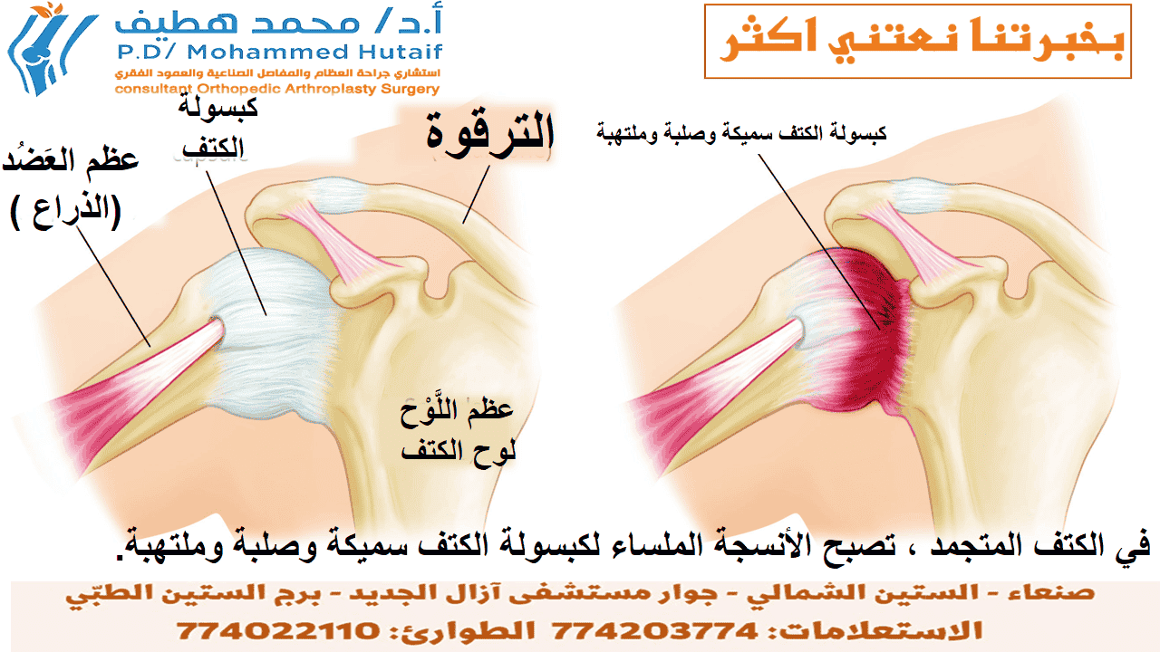  الكتف المتجمد  ملخص الكتف المتجمد ، ويسمى أيضًا التهاب المحفظة اللاصق ، يسبب ألمًا وتيبسًا في الكتف. بمرور الوقت ، يصبح من الصعب جدًا تحريك الكتف.  بعد فترة من تفاقم الأعراض ، يميل الكتف المتجمد إلى التحسن ، على الرغم من أن الشفاء التام قد يستغرق ما يصل إلى 3 سنوات. العلاج الطبيعي ، مع التركيز على مرونة الكتف ، هو العلاج الأساسي للكتف المتجمدة.  يصيب الكتف المتجمد بشكل شائع الأشخاص الذين تتراوح أعمارهم بين 40 و 60 عامًا ، ويحدث عند النساء أكثر من الرجال. بالإضافة إلى ذلك ، يتعرض مرضى السكري لخطر الإصابة بتجمد الكتف.  تزداد خطورة الإصابة بالكتف المتجمدة ما إذا كنت تتماثل للشفاء من إجراء أو حالة طبية تمنعك من تحريك ذراعك، كالسكتة الدماغية أو استئصال الثدي. الوسائط ذات الصلة تمارين تأهيل الكفة والكتف يتضمن علاج الكتف المتجمدة تمارين مدى الحركة وأحيانًا ما يتضمن الكورتيكوستيرويدات وأدوية مخدرة يتم حقنها بالمحفظة المفصلية. في نسبة صغيرة من الحالات يمكن الإشارة إلى جراحة تنظير المفصل لإرخاء المحفظة المفصلية حتى تتمكن من الحركة بحرية أكبر.  من غير الطبيعي معاودة الإصابة بالكتف المتجمدة في نفس الكتف، ولكن يمكن إصابة بعض الأشخاص في الكتف الأخرى. في هذه النشرة الكتف المتجمد- ملخص الصفحة التالية: تشريح الكتف تشريح -الكتف المتجمد كتفك عبارة عن مفصل كروي ومقبس يتكون من ثلاثة عظام: عظم الذراع العلوي (عظم العضد) وكتفك (اللوح) وعظم الترقوة   يتناسب رأس عظم العضد مع تجويف ضحل في لوح الكتف. هناك نسيج ضام قوي ، يسمى كبسولة الكتف ، يحيط بالمفصل. في هذه النشرة الكتف المتجمد- ملخص تشريح -الكتف المتجمد وصف الكتف المتجمد لمساعدة كتفك على التحرك بسهولة أكبر ، يقوم السائل الزليلي بتشحيم كبسولة الكتف والمفصل.  تشريح الكتف تحيط كبسولة الكتف بمفصل الكتف وأوتار الكفة المدورة. تحدث الإصابة بالكتف المتجمدة عندما تصبح الأنسجة الضامة التي تُغلف المفاصل سميكة ومشدودة.  الوسائط ذات الصلة تمارين تأهيل الكفة والكتف  الصفحة التالية: وصف الكتف المتجمد  وصف الكتف المتجمد في الكتف المتجمد ، تزداد سماكة كبسولة الكتف وتصبح صلبة ومشدودة. تتطور عصابات سميكة من الأنسجة - تسمى التصاقات. في كثير من الحالات ، يوجد سائل زليلي أقل في المفصل.  العلامات المميزة لهذه الحالة هي الألم الشديد وعدم القدرة على تحريك كتفك - إما بمفردك أو بمساعدة شخص آخر. يتطور على ثلاث مراحل:  مرحلة التجميد  في مرحلة 