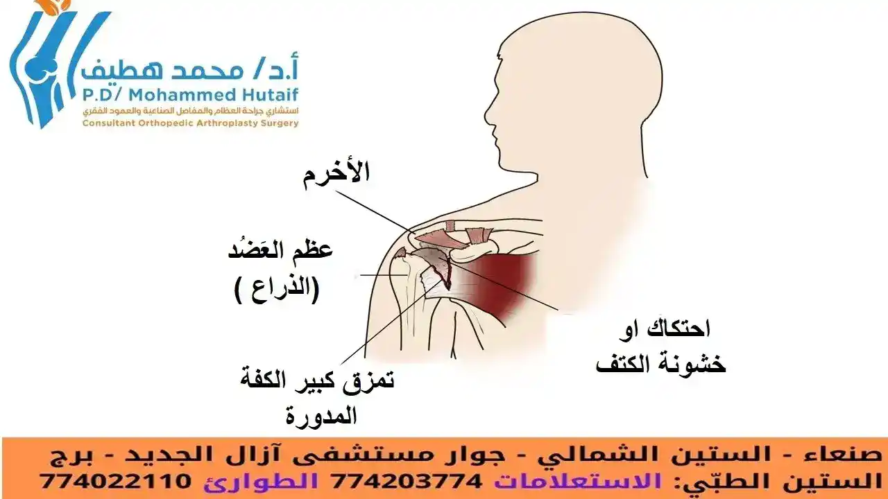 مرض نقصان الدم المزود للعظام (النخر اللاوعائي)