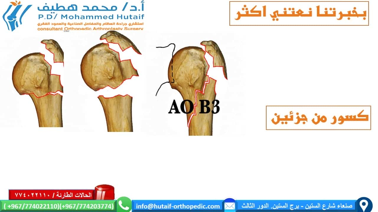 كسور راس عظم العضد القريبة الملخص كسور العضد القريبة هي إصابات شائعة للغاية ، وهي واحدة من كسور هشاشة العظام الحقيقية. يمكن معالجة معظم الكسور بشكل فعال  من غير جراحة ، حيث أن الأوعية الدموية الغنية والأسطح العريضة تمنح ميلًا كبيرًا للشفاء. بالإضافة إلى ذلك ، تؤدي العديد من أنماط الكسور إلى ملامسة عظام كافية وإزاحة أقل مع محاذاة مقبولة. يمكن أن يؤدي الرد المفتوح والتثبيت الداخلي للكسور النازحة إلى تحسين النتائج ، اعتمادًا على الحالة الوظيفية للمريض قبل الإصابة. إذا تم اختيار العلاج الجراحي ، فيجب التغلب على تحديات العلاج الفريدة ، بما في ذلك تشخيص شظايا العظام الصغيرة والحفاظ عليها مع قوى عضلية قوية ، غالبًا في العظام التي تعاني من هشاشة العظام. العديد من الخيارات مجدية ، بما في ذلك الألواح والمسامير والخيوط وغيرها من الأجهزة الجديدة.  الموقع التشريحي قد تحدث كسور راس عظم العضد في العنق الجراحي ، والرقبة التشريحية ، والحدبة الكبرى ، والحدبة الصغرى تعتبر كسور الرقبة الجراحية من جزأين أكثر شيوعًا عوامل الخطر هشاشة العظام داء السكري الصرع الإناث الإصابات المصاحبة إصابة العصب إصابة العصب الإبطي الأكثر شيوعًا إصابة الشرايين غير شائع (حدوث 5-6٪) ، احتمالية أعلى عند المرضى الأكبر سنًا غالبًا ما يحدث على مستوى الرقبة الجراحية أو مع خلع تحت الغشاء العظمي للرأس  كيف نصنف كسور العضد القريبة؟ على أساس العلاقة التشريحية المكونة من 4 أجزاء   كسور جزء واحد  كسور من جزئين  كسور من ثلاثة أجزاء  كسور من أربعة أجزاء . .  خلع وكسور إصابات سطح المفصل تمت إضافة فئات منفصلة للاضطرابات لأنها تمثل إصابات أكثر خطورة، وأكثر عرضة للإصابة بالنخر اللاوعائي وتطور التعظم غير المتجانس. وبالمثل ، تم وضع كسور السطح المفصلي في فئة منفصلة بسبب اعتبارات علاجها الفريدة. تأتي هذه في نوعين، كسور شظية للرأس وكسور انحشار.  خيارات العلاج لكسور راس عظم العضد القريبة  إذا كان كسر عظم العضد القريب غير مزاح ومستقر ، فقد تكون الإدارة غير الجراحية خيارًا قابلاً للتطبيق. قد يتألف هذا من ارتداء حامل ذراع ، والراحة ، وأدوية للألم ، وعلاج طبيعي لطيف بعد التئام الكسر. عادة ما يستغرق العظم من 8 إلى 12 أسبوعًا حتى تتكون كتلة الالتحام الأساسية. يعد الحفاظ على الذراع مدعومًا والحد من مقدار الضغط على الكسر أمرًا أساسيًا. الخيارات الجراحية  تعتمد علي عدة عوامل منها  هل الكسور مفتوحة ماهو التصنيف الدقيق للكسر؟ عمر المريض الإصابات المصاحبة  