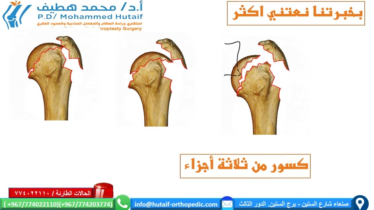 كسور راس عظم العضد القريبة الملخص كسور العضد القريبة هي إصابات شائعة للغاية ، وهي واحدة من كسور هشاشة العظام الحقيقية. يمكن معالجة معظم الكسور بشكل فعال  من غير جراحة ، حيث أن الأوعية الدموية الغنية والأسطح العريضة تمنح ميلًا كبيرًا للشفاء. بالإضافة إلى ذلك ، تؤدي العديد من أنماط الكسور إلى ملامسة عظام كافية وإزاحة أقل مع محاذاة مقبولة. يمكن أن يؤدي الرد المفتوح والتثبيت الداخلي للكسور النازحة إلى تحسين النتائج ، اعتمادًا على الحالة الوظيفية للمريض قبل الإصابة. إذا تم اختيار العلاج الجراحي ، فيجب التغلب على تحديات العلاج الفريدة ، بما في ذلك تشخيص شظايا العظام الصغيرة والحفاظ عليها مع قوى عضلية قوية ، غالبًا في العظام التي تعاني من هشاشة العظام. العديد من الخيارات مجدية ، بما في ذلك الألواح والمسامير والخيوط وغيرها من الأجهزة الجديدة.  الموقع التشريحي قد تحدث كسور راس عظم العضد في العنق الجراحي ، والرقبة التشريحية ، والحدبة الكبرى ، والحدبة الصغرى تعتبر كسور الرقبة الجراحية من جزأين أكثر شيوعًا عوامل الخطر هشاشة العظام داء السكري الصرع الإناث الإصابات المصاحبة إصابة العصب إصابة العصب الإبطي الأكثر شيوعًا إصابة الشرايين غير شائع (حدوث 5-6٪) ، احتمالية أعلى عند المرضى الأكبر سنًا غالبًا ما يحدث على مستوى الرقبة الجراحية أو مع خلع تحت الغشاء العظمي للرأس  كيف نصنف كسور العضد القريبة؟ على أساس العلاقة التشريحية المكونة من 4 أجزاء   كسور جزء واحد  كسور من جزئين  كسور من ثلاثة أجزاء  كسور من أربعة أجزاء . .  خلع وكسور إصابات سطح المفصل تمت إضافة فئات منفصلة للاضطرابات لأنها تمثل إصابات أكثر خطورة، وأكثر عرضة للإصابة بالنخر اللاوعائي وتطور التعظم غير المتجانس. وبالمثل ، تم وضع كسور السطح المفصلي في فئة منفصلة بسبب اعتبارات علاجها الفريدة. تأتي هذه في نوعين، كسور شظية للرأس وكسور انحشار.  خيارات العلاج لكسور راس عظم العضد القريبة  إذا كان كسر عظم العضد القريب غير مزاح ومستقر ، فقد تكون الإدارة غير الجراحية خيارًا قابلاً للتطبيق. قد يتألف هذا من ارتداء حامل ذراع ، والراحة ، وأدوية للألم ، وعلاج طبيعي لطيف بعد التئام الكسر. عادة ما يستغرق العظم من 8 إلى 12 أسبوعًا حتى تتكون كتلة الالتحام الأساسية. يعد الحفاظ على الذراع مدعومًا والحد من مقدار الضغط على الكسر أمرًا أساسيًا. الخيارات الجراحية  تعتمد علي عدة عوامل منها  هل الكسور مفتوحة ماهو التصنيف الدقيق للكسر؟ عمر المريض الإصابات المصاحبة  