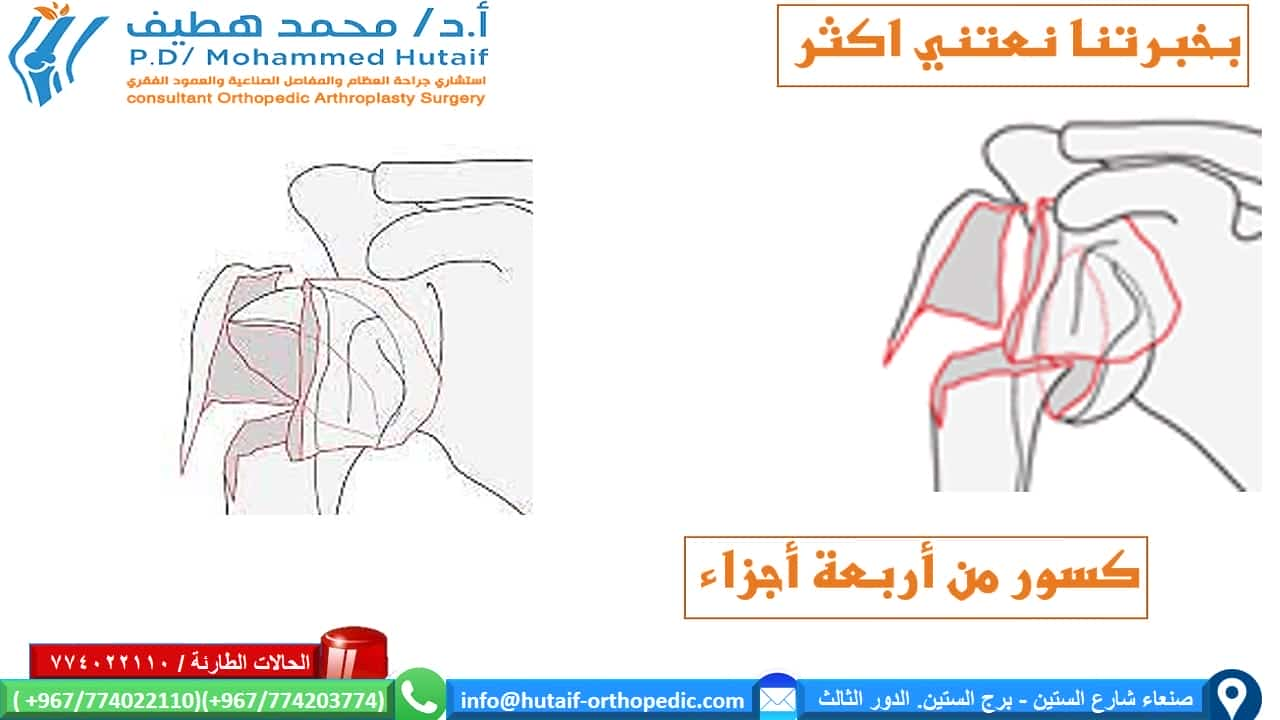 كسور راس عظم العضد القريبة الملخص كسور العضد القريبة هي إصابات شائعة للغاية ، وهي واحدة من كسور هشاشة العظام الحقيقية. يمكن معالجة معظم الكسور بشكل فعال  من غير جراحة ، حيث أن الأوعية الدموية الغنية والأسطح العريضة تمنح ميلًا كبيرًا للشفاء. بالإضافة إلى ذلك ، تؤدي العديد من أنماط الكسور إلى ملامسة عظام كافية وإزاحة أقل مع محاذاة مقبولة. يمكن أن يؤدي الرد المفتوح والتثبيت الداخلي للكسور النازحة إلى تحسين النتائج ، اعتمادًا على الحالة الوظيفية للمريض قبل الإصابة. إذا تم اختيار العلاج الجراحي ، فيجب التغلب على تحديات العلاج الفريدة ، بما في ذلك تشخيص شظايا العظام الصغيرة والحفاظ عليها مع قوى عضلية قوية ، غالبًا في العظام التي تعاني من هشاشة العظام. العديد من الخيارات مجدية ، بما في ذلك الألواح والمسامير والخيوط وغيرها من الأجهزة الجديدة.  الموقع التشريحي قد تحدث كسور راس عظم العضد في العنق الجراحي ، والرقبة التشريحية ، والحدبة الكبرى ، والحدبة الصغرى تعتبر كسور الرقبة الجراحية من جزأين أكثر شيوعًا عوامل الخطر هشاشة العظام داء السكري الصرع الإناث الإصابات المصاحبة إصابة العصب إصابة العصب الإبطي الأكثر شيوعًا إصابة الشرايين غير شائع (حدوث 5-6٪) ، احتمالية أعلى عند المرضى الأكبر سنًا غالبًا ما يحدث على مستوى الرقبة الجراحية أو مع خلع تحت الغشاء العظمي للرأس  كيف نصنف كسور العضد القريبة؟ على أساس العلاقة التشريحية المكونة من 4 أجزاء   كسور جزء واحد  كسور من جزئين  كسور من ثلاثة أجزاء  كسور من أربعة أجزاء . .  خلع وكسور إصابات سطح المفصل تمت إضافة فئات منفصلة للاضطرابات لأنها تمثل إصابات أكثر خطورة، وأكثر عرضة للإصابة بالنخر اللاوعائي وتطور التعظم غير المتجانس. وبالمثل ، تم وضع كسور السطح المفصلي في فئة منفصلة بسبب اعتبارات علاجها الفريدة. تأتي هذه في نوعين، كسور شظية للرأس وكسور انحشار.  خيارات العلاج لكسور راس عظم العضد القريبة  إذا كان كسر عظم العضد القريب غير مزاح ومستقر ، فقد تكون الإدارة غير الجراحية خيارًا قابلاً للتطبيق. قد يتألف هذا من ارتداء حامل ذراع ، والراحة ، وأدوية للألم ، وعلاج طبيعي لطيف بعد التئام الكسر. عادة ما يستغرق العظم من 8 إلى 12 أسبوعًا حتى تتكون كتلة الالتحام الأساسية. يعد الحفاظ على الذراع مدعومًا والحد من مقدار الضغط على الكسر أمرًا أساسيًا. الخيارات الجراحية  تعتمد علي عدة عوامل منها  هل الكسور مفتوحة ماهو التصنيف الدقيق للكسر؟ عمر المريض الإصابات المصاحبة  