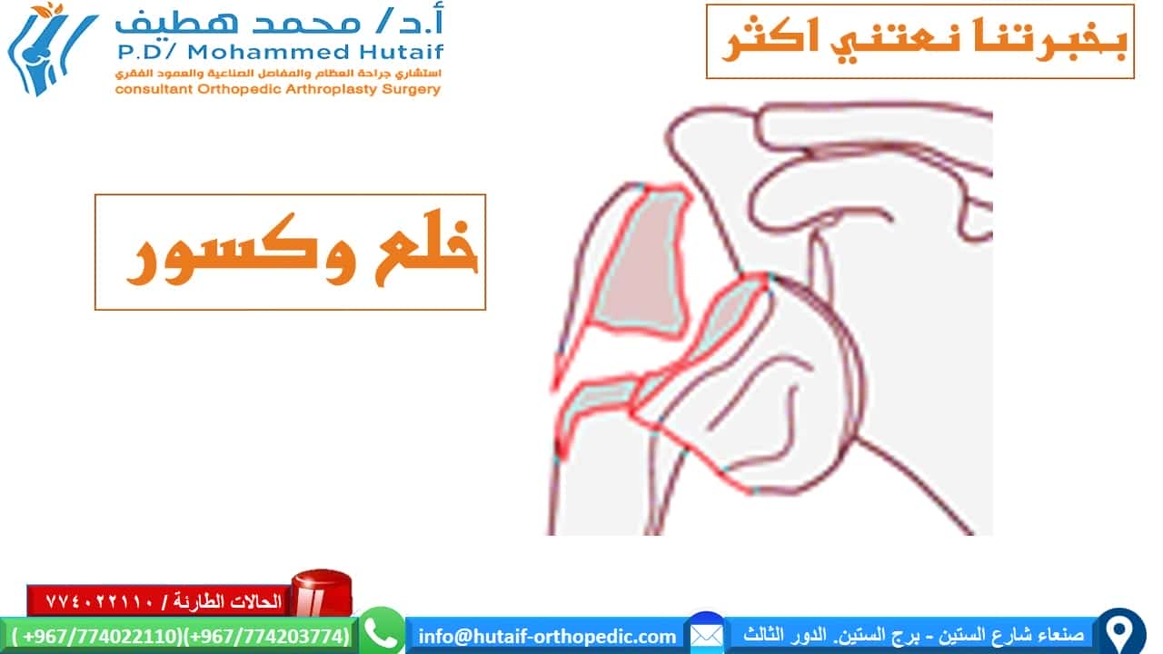 كسور راس عظم العضد القريبة الملخص كسور العضد القريبة هي إصابات شائعة للغاية ، وهي واحدة من كسور هشاشة العظام الحقيقية. يمكن معالجة معظم الكسور بشكل فعال  من غير جراحة ، حيث أن الأوعية الدموية الغنية والأسطح العريضة تمنح ميلًا كبيرًا للشفاء. بالإضافة إلى ذلك ، تؤدي العديد من أنماط الكسور إلى ملامسة عظام كافية وإزاحة أقل مع محاذاة مقبولة. يمكن أن يؤدي الرد المفتوح والتثبيت الداخلي للكسور النازحة إلى تحسين النتائج ، اعتمادًا على الحالة الوظيفية للمريض قبل الإصابة. إذا تم اختيار العلاج الجراحي ، فيجب التغلب على تحديات العلاج الفريدة ، بما في ذلك تشخيص شظايا العظام الصغيرة والحفاظ عليها مع قوى عضلية قوية ، غالبًا في العظام التي تعاني من هشاشة العظام. العديد من الخيارات مجدية ، بما في ذلك الألواح والمسامير والخيوط وغيرها من الأجهزة الجديدة.  الموقع التشريحي قد تحدث كسور راس عظم العضد في العنق الجراحي ، والرقبة التشريحية ، والحدبة الكبرى ، والحدبة الصغرى تعتبر كسور الرقبة الجراحية من جزأين أكثر شيوعًا عوامل الخطر هشاشة العظام داء السكري الصرع الإناث الإصابات المصاحبة إصابة العصب إصابة العصب الإبطي الأكثر شيوعًا إصابة الشرايين غير شائع (حدوث 5-6٪) ، احتمالية أعلى عند المرضى الأكبر سنًا غالبًا ما يحدث على مستوى الرقبة الجراحية أو مع خلع تحت الغشاء العظمي للرأس  كيف نصنف كسور العضد القريبة؟ على أساس العلاقة التشريحية المكونة من 4 أجزاء   كسور جزء واحد  كسور من جزئين  كسور من ثلاثة أجزاء  كسور من أربعة أجزاء . .  خلع وكسور إصابات سطح المفصل تمت إضافة فئات منفصلة للاضطرابات لأنها تمثل إصابات أكثر خطورة، وأكثر عرضة للإصابة بالنخر اللاوعائي وتطور التعظم غير المتجانس. وبالمثل ، تم وضع كسور السطح المفصلي في فئة منفصلة بسبب اعتبارات علاجها الفريدة. تأتي هذه في نوعين، كسور شظية للرأس وكسور انحشار.  خيارات العلاج لكسور راس عظم العضد القريبة  إذا كان كسر عظم العضد القريب غير مزاح ومستقر ، فقد تكون الإدارة غير الجراحية خيارًا قابلاً للتطبيق. قد يتألف هذا من ارتداء حامل ذراع ، والراحة ، وأدوية للألم ، وعلاج طبيعي لطيف بعد التئام الكسر. عادة ما يستغرق العظم من 8 إلى 12 أسبوعًا حتى تتكون كتلة الالتحام الأساسية. يعد الحفاظ على الذراع مدعومًا والحد من مقدار الضغط على الكسر أمرًا أساسيًا. الخيارات الجراحية  تعتمد علي عدة عوامل منها  هل الكسور مفتوحة ماهو التصنيف الدقيق للكسر؟ عمر المريض الإصابات المصاحبة  