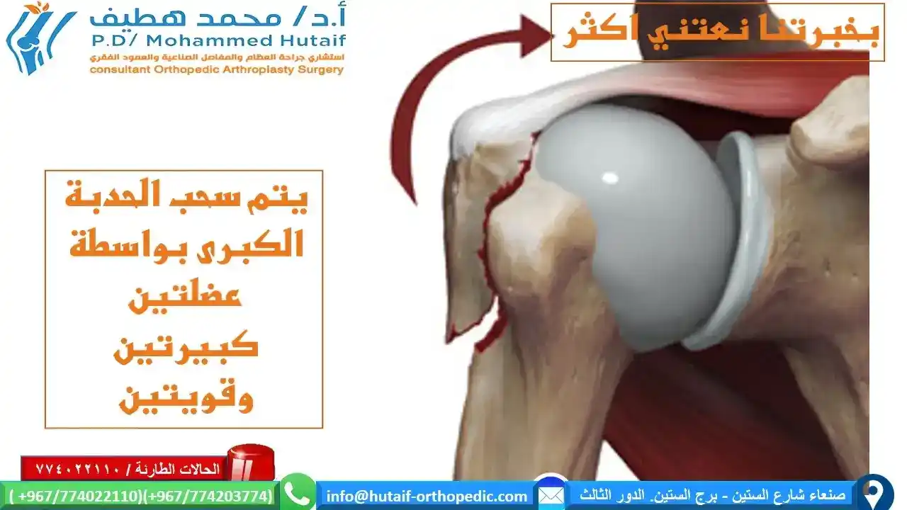 Greater Tuberosity Fractures     The greater tuberosity is the prominent area of bone at the top of the humerus and it connects with two large and powerful muscles of the rotator cuff - the supraspinatus and the subspinal muscles. It may fracture alone, or with other injuries of the shoulder joint (commonly a shoulder dislocation or complex humeral fracture).    As with most fractures it may be displaced (out of its normal position) or undisplaced.   Undisplaced Greater Tuberosity Fracture (The 'hidden fracture') I call this the 'hidden fracture' as an undisplaced fracture of the greater tuberosity is common and often does not show up on x-rays. It is common for people to injure their shoulder and x-rays look normal. This is frequently seen in skiing and mountain biking injuries. A diagnosis of 'shoulder sprain' or deltoid injury or rotator cuff injury is given and rest, rehabilitation and painkillers recommended.   If your shoulder injury is not settling in a few weeks after a fall and x-rays are normal, then you should suspect a greater tuberosity fracture. It can be very easily seen on an MRI scan and also usually on an ultrasound scan of the shoulder.  Surgery is not needed for an undisplaced fracture, but these relatively minor fractures can take a long time to heal and for the pain to settle. Shoulder stiffness and frozen shoulder is also frequent after an undisplaced greater tuberosity fracture. This may require treatment, like a true frozen shoulder. In some cases it can take up to one year to fully recover.  Displaced Greater Tuberosity Fracture  Isolated displaced greater tuberosity fractures are thought to occur in less than 2% of proximal humeral fractures, and are normally associated with anterior shoulder dislocations. The greater tuberosity fragment detaches with its attached rotator cuff and will characteristically have a longitudinal tear in the cuff between the supraspinatus and subscapularis tendons. The greater tuberosity fragment is pulled superiorly by the supraspinatus and posteriorly by infraspinatus and teres minor.  Treatment As greater tuberosity fractures are usually retracted posteriorly and superiorly, a closed reduction is difficult. If left in position, impingement will develop against the acromion, limiting elevation and external rotation of the shoulder. However if the fracture is associated with anterior dislocation then a closed reduction of the glenohumeral dislocation may successfully reduce the greater tuberosity fracture, and once it has healed, recurrent anterior instability is unlikely.  The surgical approach to this fracture is much like a rotator cuff repair, anterosuperiorly, often complete with an acromioplasty. An alternative approach is a deltoid-splitting approach, but instead of taking the deltoid off the anterior acromion, it is peeled off the posterior acromion which avoids the acromioplasty and minimizes weakening of the anterior deltoid. This approach is especailly helpful if the fragment is displaced posteriorly. Fixation of smaller fractures can be accomplished with heavy sutures, wire or occasionally, screws. Rotator cuff tears associated with the fracture are also closed. If in the case of a large greater tuberosity fracture, a deltopectoral approach would allow for more adequate exposure for reduction and proper fixation.