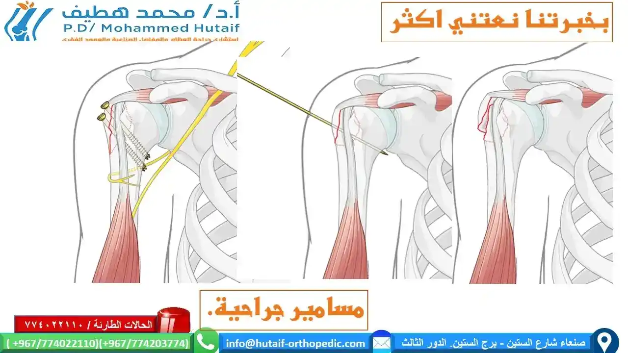 كسور الحدبة الكبرى   تعتبر الحدبة الأكبر هي المنطقة البارزة من العظم في الجزء العلوي من عظم العضد وهي تتصل بعضلتين كبيرتين وقويتين من عضلات الكفة المدورة - العضلة فوق الشوكة والعضلة تحت الشوكة.  تنكسر عند السقوط إما عن طريق الهبوط مباشرة على جانب كتفك أو الهبوط وذراعك ممدودة. قد تنكسر بمفردها ، أو مع إصابات أخرى في مفصل الكتف (عادةً خلع في الكتف أو كسر عضدي معقد).  كما هو الحال مع معظم الكسور ، قد يتم إزاحتها (خارج وضعها الطبيعي) أو عدم إزاحتها.  كسر الحدبة الكبيرة من غير إزاحة خيارات العلاج  غير جراحي- تحفظي المؤشرات الرئيسية إصابات كسور الحدبة الأكبر مع اقل من 2 مم ازاحة المؤشرات الداعمة مخاطر الجراحة تفوق الفوائد المزايا لا توجد مخاطر جراحية لا توجد مخاطر للتخدير السلبيات خطر محتمل للنزوح انظر هنا كيف تتم المعالجة غير الجراحية  خيار الجراحة  يتم اختيار الجراحة في الحالات التالية خطورة عالية للازاحة الحاجة الي تثبيت قوي من اجل حركة في وقت اقصر المزايا  تقليل مخاطر النزوح  امكانية التحريك في وقت مبكر السلبيات  الحاجة المحتملة لإزالة الأجهزة