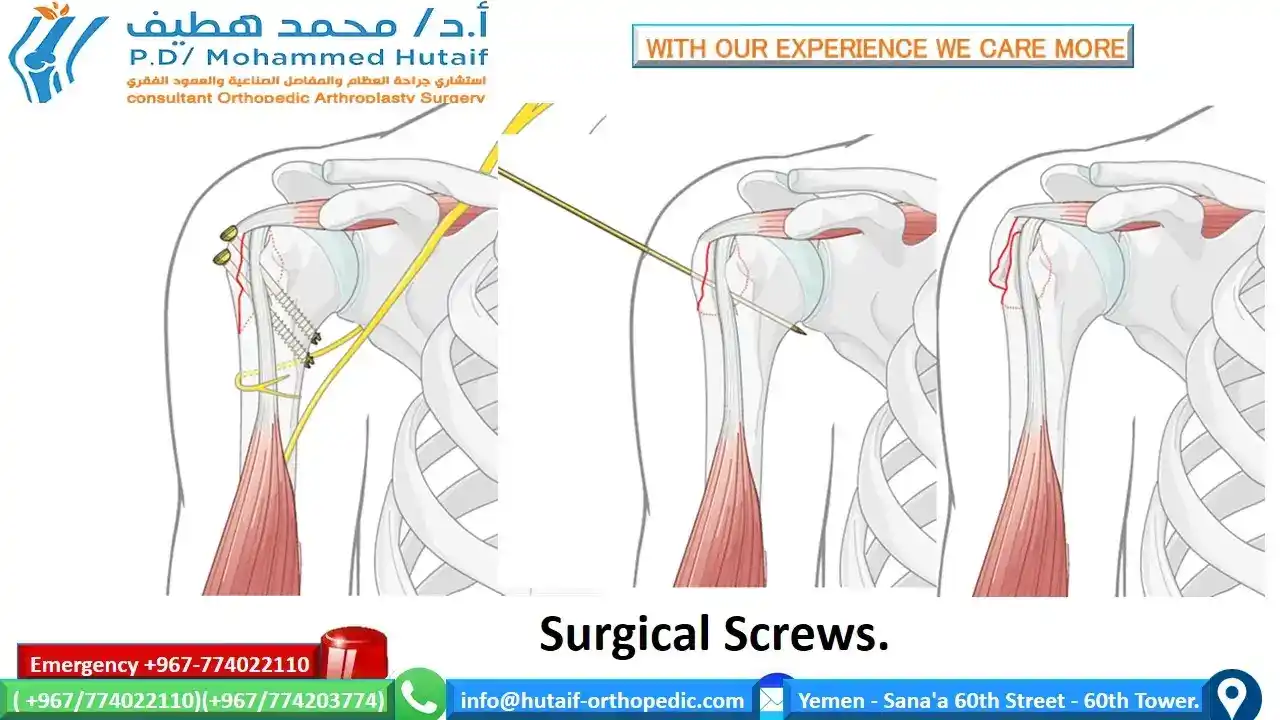 Surgical fixation for greater tuberosity fractures