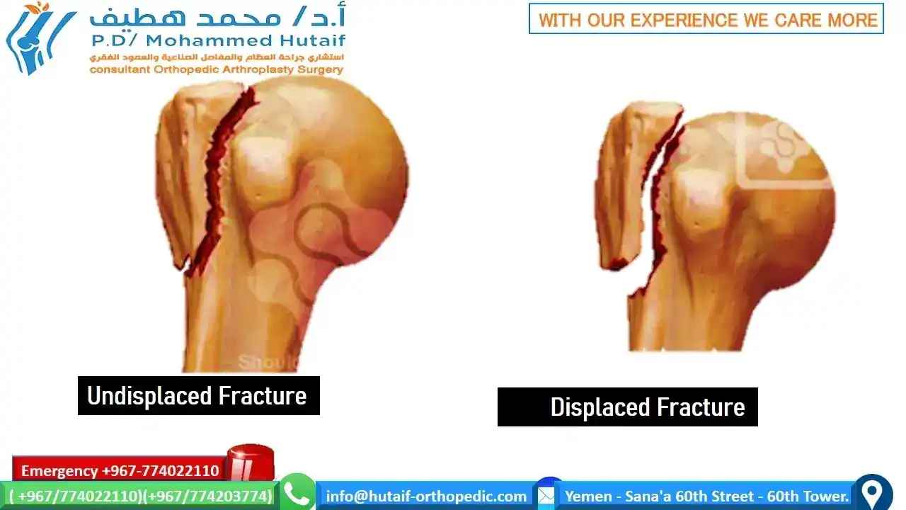 Non-surgical treatment for greater tuberosity fractures