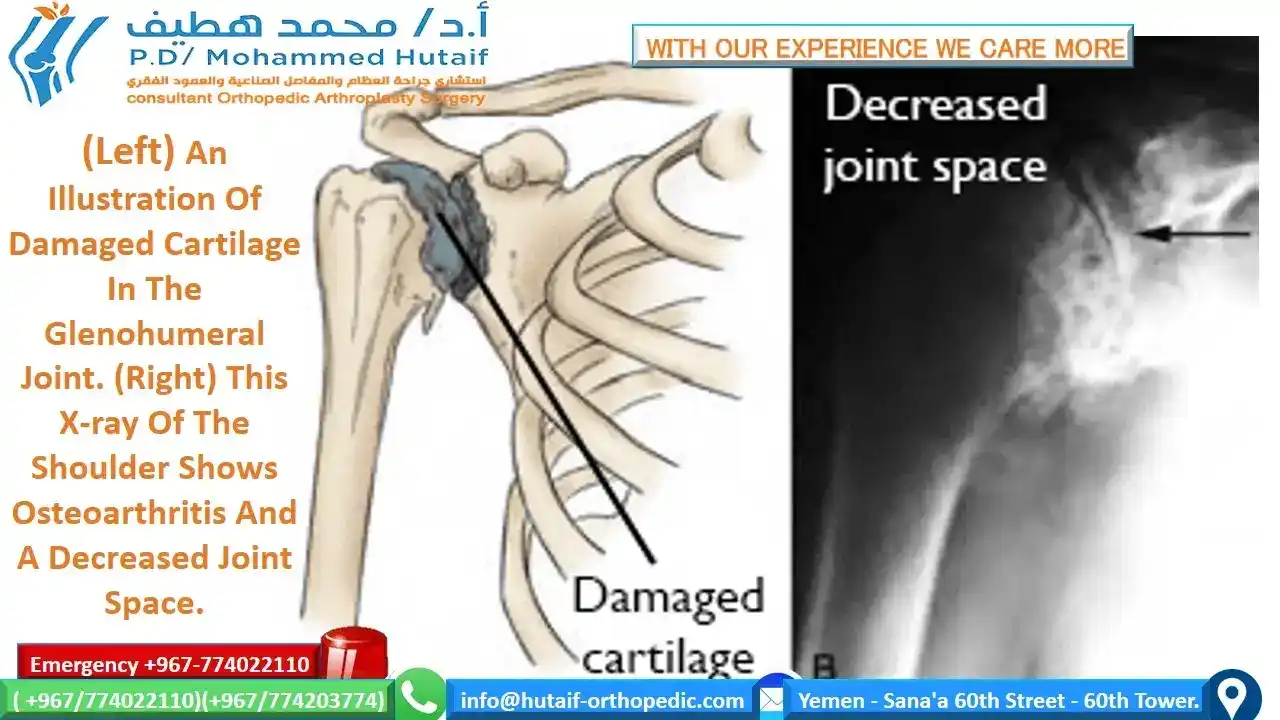 Osteoarthritis of the shoulder is a gradual wearing of the articular cartilage that leads to pain and stiffness. As the joint surface degenerates, the subchondral bone remodels, losing its sphericity and congruity. The joint capsule also becomes thickened, leading to further loss of shoulder rotation. This painful condition is a growing problem in the aging population. In most cases, diagnosis of degenerative joint disease of the shoulder can be made with careful history, physical examination, and radiography. The symptoms and degree of shoulder arthritis visible on radiography determine the best treatment option. Mild degenerative joint disease can be treated with physical therapy and over-the-counter anti-inflammatory medications such as acetaminophen or nonsteroidal anti-inflammatory drugs. More advanced cases of osteoarthritis that are refractory to nonoperative management can be managed with corticosteroid injections. In severe cases, surgery is indicated. Surgical options include arthroscopic debridement, arthroscopic capsular release, and, in the most severe instances, hemiarthroplasty or total shoulder arthroplasty.  Shoulder osteoarthritis, also known as degenerative joint disease of the shoulder, is a gradual, progressive, mechanical, and biochemical breakdown of the articular cartilage and other joint tissues, including bone and joint capsule. As the articular surface wears, friction within the joint increases, causing progressive loss of the normal load-bearing surfaces with pain and disability. There are many risk factors for shoulder osteoarthritis, including age, genetics, sex, weight, joint infection, history of shoulder dislocation, and previous injury. Certain occupations, such as heavy construction or overhead sports, are also risk factors. The prevalence of shoulder osteoarthritis is increasing as the population ages. Primary care physicians will be confronted with this disease at various levels of severity. This review highlights epidemiology, evaluation, current treatment options, and treatment results for osteoarthritis of the shoulder.  Clinical recommendation	Evidence rating	References Axillary radiography should be performed because it provides the best images of joint-space narrowing to diagnose degenerative joint disease of the shoulder. This view also helps rule out dislocation. Anteroposterior radiography with the arm actively held at 45 degrees of abduction may reveal joint-space narrowing in patients with otherwise normal neutral anteroposterior radiography.	C	10 The initial approach to early osteoarthritis should begin with activity modification, rest, and ice. Physical therapy, strength training, and aerobic exercise alleviate symptoms in certain cases; in other patients, over-the-counter medications may be sufficient for pain relief.	C	12, 23, 24 Acetaminophen should be the first pharmacologic agent used to manage pain. Therapeutic effects are achieved at dosages of 3 to 4 g per day.	C	13 The most common indications for shoulder arthroplasty are pain from shoulder arthritis with a loss of function that is unresponsive to conservative treatment; end-stage rotator cuff tear arthropathy; osteonecrosis; and a previously failed joint-sparing surgery or total shoulder arthroplasty.	C	16 Epidemiology Musculoskeletal disorders have had a significant impact on the world's population. The current decade (2000–2010) has been named the “Bone and Joint Decade.”1 In the United States alone, musculoskeletal conditions account for 131 million patient visits per year, costing society about $215 billion.1 Arthritis and chronic joint symptoms affect one out of three adults, making it the most widespread disease in America.2 The prevalence of arthritis for all joints is higher in whites, men older than 45 years, women older than 55 years, overweight and inactive persons, and persons with less than eight years of education.2 Nearly 60 percent of those affected by osteoarthritis are older than 65 years, and the incidence is increasing.20  Osteoarthritis affects many joints throughout the body.3 Although not as common as other locations, shoulder osteoarthritis is just as debilitating. The loss of shoulder function can lead to depression, anxiety, activity limitations, and job-performance problems.4 The causes of shoulder osteoarthritis are divided into primary and secondary categories. Primary osteoarthritis has no specific cause, but is more prevalent and not isolated to older persons.5 Secondary osteoarthritis has a known cause or predisposing factor, such as major shoulder trauma, chronic dislocations, infection, congenital malformations, or chronic rotator cuff tear ( Table 16).5  Type	Etiology Primary	Unknown Secondary	 Atraumatic osteonecrosis	Alcohol induced Corticosteroid therapy Cytotoxic drugs Gaucher's disease Lipid metabolism disorders Obesity Radiation Sickle cell disease Postinflammatory	Crystal arthropathies Postinfection arthritis Rheumatoid arthritis Rotator cuff arthropathy Postsurgical	Capsulorrhaphy arthropathy Intra-articular hardware (e.g., screws, staples) Overtightened anterior joint capsule (prior Putti-Platt repair) Posttraumatic	Dislocation Malunion of the proximal humerus Posttraumatic avascular necrosis Subluxation Evaluation The diagnosis of shoulder osteoarthritis involves a specific set of symptoms, physical examination findings, and changes to the bone, which are visible on radiography. The typical presenting symptom is progressive, activity-related pain that is deep in the joint and often localized posteriorly. As the disease progresses, night pain becomes more common. For many patients, the pain is present at rest and interferes with sleep. In advanced cases, the stiffness creates significant functional limitations. In younger patients, prior trauma, dislocation, or previous surgery for shoulder instability are factors associated with the development of osteoarthritis.  Patients in the early stages of degenerative joint disease may complain of mild pain and may have unremarkable examinations. Radiography may show only subtle changes to the bone until there is more advanced destruction. The only objective evidence of the disease is articular cartilage wear, which may be shown on magnetic resonance imaging (MRI). In advanced cases, there is a loss of active and passive range of motion, in addition to pain. Physical examination will reveal painful crepitus, joint enlargement, and swelling. In severe cases, audible and palpable grinding may occur when a mechanical stress is placed on the shoulder.  During the examination, it is important to exclude other shoulder pathologies that cause pain besides osteoarthritis (Table 2). Pain that is not induced by joint palpation or passive range of motion suggests bursitis, rotator cuff disease, or biceps tendinitis.7 Loss of passive and active range of motion may also occur with calcific tendinitis or idiopathic adhesive capsulitis. Radiography will show calcific tendinitis as radiodense calcium in the rotator cuff. In patients with adhesive capsulitis, shoulder joint radiography is typically normal. Morning stiffness may suggest rheumatoid arthritis. Intense inflammation, swelling, and erythema can be caused by gout, pseudo-gout, or a septic joint. A blood panel can help identify infection (i.e., white blood cell count greater than 11,000 per mm3 [11 × 109 per L] and white blood cell count in the joint fluid greater than 50,000 per mm3 [50 × 109 per L]). An erythrocyte sedimentation rate greater than 45 mm per hour may indicate rheumatoid arthritis, an underlying malignancy, or chronic infection. These blood tests are sensitive, but not specific in determining causes of shoulder pain.8  Finding	Probable diagnosis History Joint effusion	Osteoarthritis Rheumatoid arthritis Septic arthritis Morning stiffness improved with activity	Rheumatoid arthritis Night time shoulder pain	Impingement Rotator cuff disease (partial or complete cuff tears) Pain or “clunking” sound with overhead motion	Labral disorder Pain radiating down arm	Disk disease (cervical) Stiffness worse with activity, improves with rest	Osteoarthritis Physical examination Cervical range of motion decreased	Disk disease (cervical) Crepitus	Osteoarthritis Rheumatoid arthritis Decreased range of motion, specifically external rotation and abduction	Osteoarthritis Soft tissue injury (frozen shoulder) Erythema, warmth	Septic arthritis Rheumatoid arthritis Shoulder joint line tenderness	Osteoarthritis Radiography Joint space narrowing (central, posterior, and superior erosion)	Cufftear arthropathy Osteoarthritis Rheumatoid arthritis Marginal joint erosions	Rheumatoid arthritis Normal joint	Frozen shoulder Septic arthritis Osteophytes	Osteoarthritis Subchondral sclerosis	Osteoarthritis Imaging studies are essential to diagnosing degenerative joint disease. In most cases, conventional radiography demonstrates shoulder osteoarthritis9 (Table 2). Early in the disease process, radiographic evidence of degenerative joint disease may include joint-space narrowing (mild), osteophytes (small), subchondral sclerosis, cysts, and eburnation or advanced articular cartilage loss (Figure 1). The axillary view provides the best image to look for joint-space narrowing and helps rule out dislocations. Anteroposterior radiography, with the arm held at 45 degrees of abduction, may also show early joint-space narrowing.10 Computed tomography arthrograms can localize articular defects, whereas MRI reveals soft-tissue pathologies and subtle changes in articular cartilage. Subchondral edema visible on MRI suggests advanced articular cartilage involvement.11   Current Treatment Options MEDICAL MANAGEMENT Presently, there are no known interventions that alter the natural history of early osteoarthritis; therefore, the main objectives in treatment are to control pain and restore function. The initial approach to osteoarthritis treatment begins with activity modification, rest, and ice. Physical therapy, strength training, and aerobic exercise help alleviate symptoms.12 Acetaminophen should be the first pharmacologic agent used to manage pain, with therapeutic effects achieved at dosages of 3 to 4 g per day.13 Nutritional supplements, such as glucosamine and chondroitin, are pharmacologic alternatives to acetaminophen, although only anecdotal evidence supports their use for shoulder osteoarthritis.  The mainstay of pharmacotherapy for degenerative joint disease has been the nonselective and selective cyclooxygenase-2 (COX-2) inhibitors, or nonsteroidal anti-inflammatory drugs (NSAIDs) (Table 314). Nonselective COX-2 inhibitors (e.g., ibuprofen [Motrin], diclofenac [Voltaren], naproxen [Naprosyn]) and selective COX-2 inhibitors (e.g., celecoxib [Celebrex]) have been effective in alleviating osteoarthritis symptoms, but have varying side effects. Side effects can include gastrointestinal irritation, stomach ulcerations, bleeding, or renal failure from long-term use. In advanced osteoarthritis cases with inflammation, an injection of a corticosteroid, such as triamcinolone acetonide (Kenalog; 1 to 2 mL of 40 mg per mL) with lidocaine 1% (Xylocaine), into the affected joint can help relieve pain and swelling.  Cardiovascular risk level	No or low NSAID gastrointestinal risk	NSAID gastrointestinal risk No cardiovascular risk (no aspirin)	Traditional NSAID	Consider non-NSAID therapy Traditional NSAID plus PPI or COX-2 inhibitor plus PPI* (if necessary) Cardiovascular risk (consider aspirin)	Consider non-NSAID therapy	Consider non-NSAID therapy Traditional NSAID† plus PPI if gastrointestinal risk warrants gastroprotection	A gastroprotective agent must be added if a traditional NSAID† is prescribed SURGICAL MANAGEMENT If conservative therapies fail, there are many surgical options available. Joint preservation surgery is preferable for patients younger than 55 to 60 years or those with early stage degenerative joint disease of the shoulder. The operative procedure should match the patient's symptoms or functional limitations. Arthroscopic debridement, capsular release, corrective osteotomies, and interposition arthroplasty are surgical options that attempt to reduce symptoms while preserving the native joint.15 Arthroscopic debridement with capsular release is the most common surgical treatment. It is most effective in patients younger than 55 to 60 years with moderate pain and significant passive motion restrictions. Debridement removes mechanical irritants, unstable cartilage flaps, or loose bodies. Inflamed synovium can be treated via synovectomy, and the stiff contracted joint capsule can be released to restore passive joint mobility and unload articular surfaces. Arthrodesis (shoulder fusion) is an option for patients younger than 45 to 50 years with severe arthritis or for those who are not suitable candidates for total shoulder replacement. This procedure eliminates pain by fusing the humeral head to the glenoid, thus eliminating painful motion interface.  Shoulder arthroplasty is recommended for patients with severe shoulder osteoarthritis. The most common indications for shoulder arthroplasty are pain from shoulder arthritis with a loss of function that is unresponsive to conservative treatment; end-stage rotator cuff tear arthropathy; osteonecrosis; and a previously failed joint-sparing surgery or total shoulder arthroplasty.16 Most recent studies support the use of a total shoulder arthroplasty, which involves replacing the glenoid and humerus 17,18 (Figure 2). In certain instances, a hemiarthroplasty (humerus only) may be an acceptable option. Major contraindications to shoulder replacement are: active or recent infection, neuropathic joint, complete paralysis of deltoid or rotator cuff muscles, debilitating medical status, or uncorrectable shoulder instability.   Shoulder arthroplasty is typically done under general anesthesia. A regional nerve anesthetic (interscalene block) can supplement general anesthesia and provide perioperative pain control. After careful surgical exposure, the glenoid fossa is resurfaced with a solid polyethylene component, and the humeral head is resected along the anatomic neck and replaced with a metal prosthesis. Newer prostheses, called reverse or inverse shoulder replacements, have been designed specifically for use in rotator-cuff–deficient shoulders. The procedure lasts one to three hours, followed by a two- to four-day postoperative hospitalization. Blood loss is minimal, and patients who start with a preoperative hemoglobin above 11 g per dL (110 g per L) should not need transfusions. Donating blood before surgery is not recommended.19 Pain is controlled in the hospital with opioids via intravenous patient-controlled analgesia. A sling should be used for three to six weeks to protect the repair. Patients usually require some assistance with normal daily activities for approximately four to six weeks after surgery.  Postoperative rehabilitation begins immediately with joint motion, in-home exercises, and a therapist-supervised program (Table 4).20 The initial six weeks of rehabilitation focus on stretching exercises to optimize the flexibility of the joint. When flexibility and range-of-motion goals have been achieved (usually at six to eight weeks), the strengthening can begin. Normal activities of daily living can be resumed within six weeks of surgery, and patients can often return to athletic activities within four months. After shoulder arthroplasty, patients can expect alleviation of pain and a significant improvement in range of motion.18 Improvement in function may continue up to two years after surgery.21  Exercise	Postoperative day Active hand, forearm, elbow motion	1 Passive shoulder motion	1 Pulley	21 Wand or cane	35 Isometrics	35 Treatment Results NONSURGICAL TREATMENT Nonsurgical osteoarthritis treatments can temporize symptoms; however, they do not alter natural history and have had unsatisfactory results. Nonpharmacologic measures, such as aerobic exercise and strengthening, are unproven in the shoulder.22 One study has shown that acetaminophen was more effective than placebo at pain reduction, but less effective than NSAIDs.23 NSAIDs were also associated with more frequent gastrointestinal events than acetaminophen.23 Two randomized placebo-controlled studies have been published since 2003. One found no significant difference between placebo and acetaminophen, and the other found acetaminophen to be more effective than placebo, and celecoxib to be more effective than acetaminophen.13,24  Pharmacologic results show that newer COX-2 selective inhibitors are not more effective than nonselective NSAIDs for treating knee and hip osteoarthritis.25,26 However, the Celecoxib Long Term Arthritis Safety Study (CLASS) illustrated that the COX-2 inhibitor celecoxib was associated with significantly less gastrointestinal events than traditional NSAIDs.27 In recent years, studies have shown certain COX-2 inhibitors to be associated with an increased cardiovascular risk, resulting in the removal of rofecoxib (Vioxx) from the market. Additional data suggest that the nonselective NSAIDs may also cause an increase in adverse cardiovascular events.28,29 More studies are needed to demonstrate effectiveness and serious cardiovascular side effects of NSAIDs and COX-2 selective inhibitors.  Nutritional supplements are widely used for osteoarthritis treatment, although the U.S. Food and Drug Administration has not approved them for this use. The most common supplements are glucosamine and chondroitin. Glucosamine has been shown to provide moderate symptomatic relief over placebo, but the overall effectiveness of these supplements remains uncertain.30 At this time, there is a paucity of evidence to support the use of these supplements in shoulder degenerative joint disease.  SURGICAL TREATMENT Few studies exist on joint-preservation surgery for the shoulder. There are several case reports and small series that present cartilage resurfacing procedures for young patients with focal chondral defects.31,32 The largest series on arthroscopic treatment consists of 25 patients with early to moderate osteoarthritis, treated with lavage, partial synovectomy, and subacromial decompression.15 The mean follow-up was 34 months, and the authors demonstrated good or excellent outcomes in 80 percent of patients. The authors concluded that arthroscopic debridement was reasonable for early shoulder osteoarthritis treatment. Surgical prerequisites included concentric humeral head and glenoid with visible joint space on axillary radiography.  Prosthetic total shoulder arthroplasty is the treatment of choice for severe degenerative joint disease. Studies show that total shoulder arthroplasty provides excellent clinical results with good durability. The results of total shoulder arthroplasty have been shown to be superior to hemiarthroplasty, in which only the humerus is resurfaced.33 As early as 1982, one study reported that 90 percent of patients who underwent total shoulder arthroplasty had satisfactory results at minimum two-year follow-up.34 As of 1988, only two of the 615 patients who had undergone total shoulder arthroplasty required further surgery. Another paper with 12-year mean follow-up demonstrated satisfactory pain relief in 83 percent of shoulders, with an average improvement of 40-degree active abduction, and yielding an overall average range of motion of 117 degrees.18 Despite concerns about glenoid loosening, long-term studies have shown high rates of survivorship. Another study of patients younger than 50 years, with minimum five-year and mean 12-year follow-up, found a prosthesis survival rate of 97 percent at five years, 97 percent at 10 years, and 84 percent at 15 years.16 This study illustrates that total shoulder arthroplasty improves functional range of motion with good long-term pain relief.  The average orthopedic surgeon performs only two total shoulder arthroplasties per year, and recent data has shown that surgeon and hospital volume significantly influence surgical outcomes.32,35 Surgeons with higher volumes of arthroplasties have better patient outcomes and fewer complications. When total shoulder arthroplasty is performed under appropriate clinical indication, complete pain relief and normal or near-normal restoration of function is often the result. Experts predict that surgical outcomes following total shoulder arthroplasty will continue to improve with newer implant designs and fixation methods.Shoulder Osteoarthritis (Degenerative Arthritis of the Shoulder)  Medically Reviewed by David Zelman, MD on November 06, 2020 ARTICLES ON OSTEOARTHRITIS TYPES Foot and Ankle Osteoarthritis Hip Osteoarthritis (Degenerative Arthritis of the Hip) Spinal Osteoarthritis (Degenerative Arthritis of the Spine) Cervical Osteoarthritis (Cervical Spondylosis) Hand Osteoarthritis (Degenerative Arthritis of the Hand) Shoulder Osteoarthritis (Degenerative Arthritis of the Shoulder) Osteoarthritis of the Knee (Degenerative Arthritis of the Knee) Your risk of developing osteoarthritis of the shoulder with its pain and physical limitations increases with age. But an injury, such as a dislocated shoulder, can lead to shoulder osteoarthritis even in young people. Here is information about the causes of and treatments for shoulder osteoarthritis. Read on to learn how an arthritic shoulder can affect your range of motion and ability to do everyday things, and discover ways to treat and manage the condition.  What Is Osteoarthritis? Osteoarthritis -- also known as degenerative joint disease -- occurs when the cartilage that covers the tops of bones, known as articular cartilage, degenerates or wears down. This causes swelling, pain, and sometimes the development of osteophytes -- bone spurs -- when the ends of the two bones rub together.  What Is Osteoarthritis of the Shoulder? The shoulder is made up of two joints, the acromioclavicular (AC) joint and the glenohumeral joint. The AC joint is the point where the collarbone, or clavicle, meets the acromion, which is the tip of the shoulder blade. The glenohumeral joint is the point where the top of the arm bone, or humerus, meets the shoulder blade, or scapula. Osteoarthritis is more commonly found in the AC joint.  Who Gets Shoulder Osteoarthritis? Osteoarthritis most often occurs in people who are over age 50. In younger people, osteoarthritis can result from an injury or trauma, such as a fractured or dislocated shoulder. This is known as posttraumatic arthritis. Osteoarthritis may also be hereditary.  What Are the Symptoms of Shoulder Osteoarthritis? As with most types of osteoarthritis, pain is a key symptom. A person with shoulder arthritis is likely to have pain while moving the shoulder and after moving the shoulder. The person can even have pain while sleeping.  Another symptom may be a limited range of motion. This limitation can be seen when you are trying to move your arm. It can also be evident if someone is moving your arm to assess range of motion. Moving the shoulder might also produce a clicking or creaking noise.  How Is Shoulder Osteoarthritis Diagnosed? To diagnose shoulder osteoarthritis, the doctor will take a medical history and do a physical exam to assess pain, tenderness, and loss of motion and to look for other signs in surrounding tissues. At this point, the doctor may be able to tell if the muscle near the joint has signs of atrophy, or weakness, from lack of use.  Tests that might be ordered to diagnose osteoarthritis of the shoulder include:  X-rays Blood tests, mainly to look for rheumatoid arthritis, but also to exclude other diseases Removal of synovial fluid, the lubricating fluid in the lining (synovium) of the joint, for analysis MRI scans    How Is Osteoarthritis of the Shoulder Treated? The first treatments for osteoarthritis, including osteoarthritis of the shoulder, do not involve surgery. These treatments include:  Resting the shoulder joint. This could mean that the person with arthritis has to change the way they move the arm while performing the activities of daily living. For example, the person might wear clothing that zips up the front instead of clothing that goes over the head. Or the person might prop up hair dryers instead of holding them up for long periods of time. Taking over-the-counter nonsteroidal anti-inflammatory drugs, such as ibuprofen or aspirin. These drugs, also called NSAIDS, will reduce inflammation and pain. Check with your doctor to make sure you can take these drugs safely. Performing physical therapy as assigned by the doctor. Performing range-of-motion exercises. These exercises are used as an attempt to increase flexibility. Applying moist heat. Applying ice to the shoulder. Ice is applied for 20 minutes two or three times a day to decrease inflammation and pain. Using other medications prescribed by the doctor. These might include injections of corticosteroids, for example. Taking the dietary supplements glucosamine and chondroitin. Many people claim relief with these supplements. Evidence is conflicting as to whether they really help. You should discuss using these with your doctor because the supplements may interact with other drugs. If nonsurgical treatments do not work effectively, there are surgeries available. As with any surgery, there are certain risks and potential complications, including infection or problems with anesthesia. Surgical treatments include:  Shoulder joint replacement (total shoulder arthroplasty). Replacing the whole shoulder with an artificial joint is usually done to treat arthritis of the glenohumeral joint. Replacement of the head of the humerus, or upper arm bone (hemiarthroplasty). This option, too, is used to treat arthritis of the glenohumeral joint. Removal of a small piece of the end of the collarbone (resection arthroplasty). This option is the most common surgery for treating arthritis of the AC joint and associated rotator cuff problems. After the removal of the end of the bone, the space fills with scar tissue.