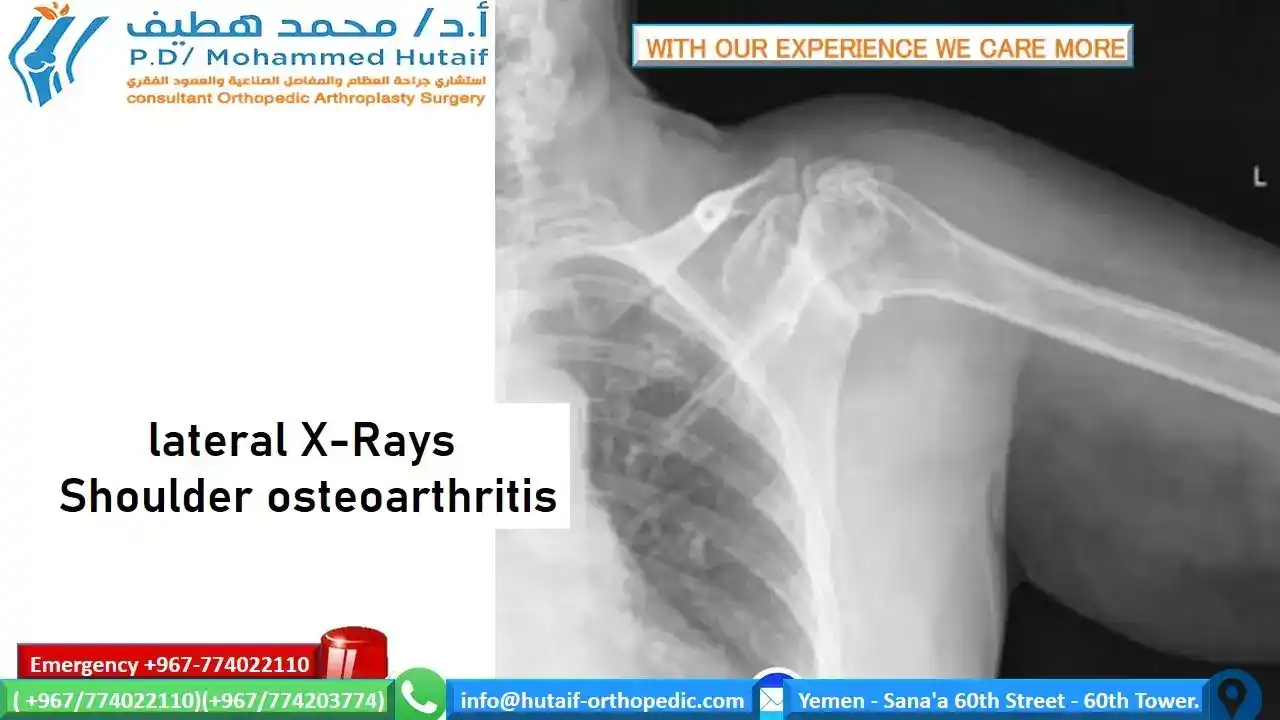 Your risk of developing osteoarthritis of the shoulder with its pain and physical limitations increases with age. But an injury, such as a dislocated shoulder, can lead to shoulder osteoarthritis even in young people. Here is information about the causes of and treatments for shoulder osteoarthritis. Read on to learn how an arthritic shoulder can affect your range of motion and ability to do everyday things, and discover ways to treat and manage the condition.  What Is Osteoarthritis? Osteoarthritis -- also known as degenerative joint disease -- occurs when the cartilage that covers the tops of bones, known as articular cartilage, degenerates or wears down. This causes swelling, pain, and sometimes the development of osteophytes -- bone spurs -- when the ends of the two bones rub together.  What Is Osteoarthritis of the Shoulder? The shoulder is made up of two joints, the acromioclavicular (AC) joint and the glenohumeral joint. The AC joint is the point where the collarbone, or clavicle, meets the acromion, which is the tip of the shoulder blade. The glenohumeral joint is the point where the top of the arm bone, or humerus, meets the shoulder blade, or scapula. Osteoarthritis is more commonly found in the AC joint.   Who Gets Shoulder Osteoarthritis? Osteoarthritis most often occurs in people who are over age 50. In younger people, osteoarthritis can result from an injury or trauma, such as a fractured or dislocated shoulder. This is known as posttraumatic arthritis. Osteoarthritis may also be hereditary.  What Are the Symptoms of Shoulder Osteoarthritis? As with most types of osteoarthritis, pain is a key symptom. A person with shoulder arthritis is likely to have pain while moving the shoulder and after moving the shoulder. The person can even have pain while sleeping.   Another symptom may be a limited range of motion. This limitation can be seen when you are trying to move your arm. It can also be evident if someone is moving your arm to assess range of motion. Moving the shoulder might also produce a clicking or creaking noise.  How Is Shoulder Osteoarthritis Diagnosed? To diagnose shoulder osteoarthritis, the doctor will take a medical history and do a physical exam to assess pain, tenderness, and loss of motion and to look for other signs in surrounding tissues. At this point, the doctor may be able to tell if the muscle near the joint has signs of atrophy, or weakness, from lack of use.  Tests that might be ordered to diagnose osteoarthritis of the shoulder include:  X-rays Blood tests, mainly to look for rheumatoid arthritis, but also to exclude other diseases Removal of synovial fluid, the lubricating fluid in the lining (synovium) of the joint, for analysis MRI scans     How Is Osteoarthritis of the Shoulder Treated? The first treatments for osteoarthritis, including osteoarthritis of the shoulder, do not involve surgery. These treatments include:  Resting the shoulder joint. This could mean that the person with arthritis has to change the way they move the arm while performing the activities of daily living. For example, the person might wear clothing that zips up the front instead of clothing that goes over the head. Or the person might prop up hair dryers instead of holding them up for long periods of time. Taking over-the-counter nonsteroidal anti-inflammatory drugs, such as ibuprofen or aspirin. These drugs, also called NSAIDS, will reduce inflammation and pain. Check with your doctor to make sure you can take these drugs safely. Performing physical therapy as assigned by the doctor. Performing range-of-motion exercises. These exercises are used as an attempt to increase flexibility. Applying moist heat. Applying ice to the shoulder. Ice is applied for 20 minutes two or three times a day to decrease inflammation and pain. Using other medications prescribed by the doctor. These might include injections of corticosteroids, for example. Taking the dietary supplements glucosamine and chondroitin. Many people claim relief with these supplements. Evidence is conflicting as to whether they really help. You should discuss using these with your doctor because the supplements may interact with other drugs. If nonsurgical treatments do not work effectively, there are surgeries available. As with any surgery, there are certain risks and potential complications, including infection or problems with anesthesia. Surgical treatments include:  Shoulder joint replacement (total shoulder arthroplasty). Replacing the whole shoulder with an artificial joint is usually done to treat arthritis of the glenohumeral joint. Replacement of the head of the humerus, or upper arm bone (hemiarthroplasty). This option, too, is used to treat arthritis of the glenohumeral joint. Removal of a small piece of the end of the collarbone (resection arthroplasty). This option is the most common surgery for treating arthritis of the AC joint and associated rotator cuff problems. After the removal of the end of the bone, the space fills with scar tissue.  Show Sources