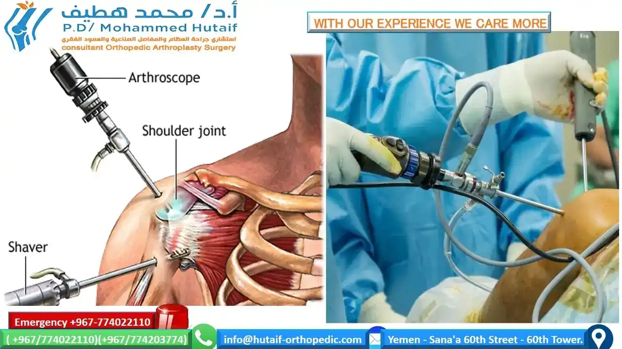 Osteoarthritis of the shoulder is a gradual wearing of the articular cartilage that leads to pain and stiffness. As the joint surface degenerates, the subchondral bone remodels, losing its sphericity and congruity. The joint capsule also becomes thickened, leading to further loss of shoulder rotation. This painful condition is a growing problem in the aging population. In most cases, diagnosis of degenerative joint disease of the shoulder can be made with careful history, physical examination, and radiography. The symptoms and degree of shoulder arthritis visible on radiography determine the best treatment option. Mild degenerative joint disease can be treated with physical therapy and over-the-counter anti-inflammatory medications such as acetaminophen or nonsteroidal anti-inflammatory drugs. More advanced cases of osteoarthritis that are refractory to nonoperative management can be managed with corticosteroid injections. In severe cases, surgery is indicated. Surgical options include arthroscopic debridement, arthroscopic capsular release, and, in the most severe instances, hemiarthroplasty or total shoulder arthroplasty.  Shoulder osteoarthritis, also known as degenerative joint disease of the shoulder, is a gradual, progressive, mechanical, and biochemical breakdown of the articular cartilage and other joint tissues, including bone and joint capsule. As the articular surface wears, friction within the joint increases, causing progressive loss of the normal load-bearing surfaces with pain and disability. There are many risk factors for shoulder osteoarthritis, including age, genetics, sex, weight, joint infection, history of shoulder dislocation, and previous injury. Certain occupations, such as heavy construction or overhead sports, are also risk factors. The prevalence of shoulder osteoarthritis is increasing as the population ages. Primary care physicians will be confronted with this disease at various levels of severity. This review highlights epidemiology, evaluation, current treatment options, and treatment results for osteoarthritis of the shoulder.  SORT: KEY RECOMMENDATIONS FOR PRACTICE zoom_out_map Enlarge print Print Clinical recommendation	Evidence rating	References Axillary radiography should be performed because it provides the best images of joint-space narrowing to diagnose degenerative joint disease of the shoulder. This view also helps rule out dislocation. Anteroposterior radiography with the arm actively held at 45 degrees of abduction may reveal joint-space narrowing in patients with otherwise normal neutral anteroposterior radiography.	C	10 The initial approach to early osteoarthritis should begin with activity modification, rest, and ice. Physical therapy, strength training, and aerobic exercise alleviate symptoms in certain cases; in other patients, over-the-counter medications may be sufficient for pain relief.	C	12, 23, 24 Acetaminophen should be the first pharmacologic agent used to manage pain. Therapeutic effects are achieved at dosages of 3 to 4 g per day.	C	13 The most common indications for shoulder arthroplasty are pain from shoulder arthritis with a loss of function that is unresponsive to conservative treatment; end-stage rotator cuff tear arthropathy; osteonecrosis; and a previously failed joint-sparing surgery or total shoulder arthroplasty.	C	16 A = consistent, good-quality patient-oriented evidence; B = inconsistent or limited-quality patient-oriented evidence; C = consensus, disease-oriented evidence, usual practice, expert opinion, or case series. For information about the SORT evidence rating system, go to https://www.aafp.org/afpsort.xml.  Epidemiology Musculoskeletal disorders have had a significant impact on the world's population. The current decade (2000–2010) has been named the “Bone and Joint Decade.”1 In the United States alone, musculoskeletal conditions account for 131 million patient visits per year, costing society about $215 billion.1 Arthritis and chronic joint symptoms affect one out of three adults, making it the most widespread disease in America.2 The prevalence of arthritis for all joints is higher in whites, men older than 45 years, women older than 55 years, overweight and inactive persons, and persons with less than eight years of education.2 Nearly 60 percent of those affected by osteoarthritis are older than 65 years, and the incidence is increasing.20  Osteoarthritis affects many joints throughout the body.3 Although not as common as other locations, shoulder osteoarthritis is just as debilitating. The loss of shoulder function can lead to depression, anxiety, activity limitations, and job-performance problems.4 The causes of shoulder osteoarthritis are divided into primary and secondary categories. Primary osteoarthritis has no specific cause, but is more prevalent and not isolated to older persons.5 Secondary osteoarthritis has a known cause or predisposing factor, such as major shoulder trauma, chronic dislocations, infection, congenital malformations, or chronic rotator cuff tear ( Table 16).5  TABLE 1  Classification of Degenerative Arthritis of the Glenohumeral Joint zoom_out_map Enlarge print Print Type	Etiology Primary	Unknown Secondary	 Atraumatic osteonecrosis	Alcohol induced Corticosteroid therapy Cytotoxic drugs Gaucher's disease Lipid metabolism disorders Obesity Radiation Sickle cell disease Postinflammatory	Crystal arthropathies Postinfection arthritis Rheumatoid arthritis Rotator cuff arthropathy Postsurgical	Capsulorrhaphy arthropathy Intra-articular hardware (e.g., screws, staples) Overtightened anterior joint capsule (prior Putti-Platt repair) Posttraumatic	Dislocation Malunion of the proximal humerus Posttraumatic avascular necrosis Subluxation Adapted with permission from Gerber A, Lehtinen JT, Warner JJ. Glenohumeral osteoarthritis in active patients: diagnostic tips and complete management options. Phys Sportsmed. 2003;4(31). http://www.physsportsmed.com/issues/2003/0403/gerber.htm. Accessed April 21, 2008.  Evaluation The diagnosis of shoulder osteoarthritis involves a specific set of symptoms, physical examination findings, and changes to the bone, which are visible on radiography. The typical presenting symptom is progressive, activity-related pain that is deep in the joint and often localized posteriorly. As the disease progresses, night pain becomes more common. For many patients, the pain is present at rest and interferes with sleep. In advanced cases, the stiffness creates significant functional limitations. In younger patients, prior trauma, dislocation, or previous surgery for shoulder instability are factors associated with the development of osteoarthritis.  Patients in the early stages of degenerative joint disease may complain of mild pain and may have unremarkable examinations. Radiography may show only subtle changes to the bone until there is more advanced destruction. The only objective evidence of the disease is articular cartilage wear, which may be shown on magnetic resonance imaging (MRI). In advanced cases, there is a loss of active and passive range of motion, in addition to pain. Physical examination will reveal painful crepitus, joint enlargement, and swelling. In severe cases, audible and palpable grinding may occur when a mechanical stress is placed on the shoulder.  During the examination, it is important to exclude other shoulder pathologies that cause pain besides osteoarthritis (Table 2). Pain that is not induced by joint palpation or passive range of motion suggests bursitis, rotator cuff disease, or biceps tendinitis.7 Loss of passive and active range of motion may also occur with calcific tendinitis or idiopathic adhesive capsulitis. Radiography will show calcific tendinitis as radiodense calcium in the rotator cuff. In patients with adhesive capsulitis, shoulder joint radiography is typically normal. Morning stiffness may suggest rheumatoid arthritis. Intense inflammation, swelling, and erythema can be caused by gout, pseudo-gout, or a septic joint. A blood panel can help identify infection (i.e., white blood cell count greater than 11,000 per mm3 [11 × 109 per L] and white blood cell count in the joint fluid greater than 50,000 per mm3 [50 × 109 per L]). An erythrocyte sedimentation rate greater than 45 mm per hour may indicate rheumatoid arthritis, an underlying malignancy, or chronic infection. These blood tests are sensitive, but not specific in determining causes of shoulder pain.8  TABLE 2  Diagnosis of Shoulder Pathologies zoom_out_map Enlarge print Print Finding	Probable diagnosis History Joint effusion	Osteoarthritis Rheumatoid arthritis Septic arthritis Morning stiffness improved with activity	Rheumatoid arthritis Night time shoulder pain	Impingement Rotator cuff disease (partial or complete cuff tears) Pain or “clunking” sound with overhead motion	Labral disorder Pain radiating down arm	Disk disease (cervical) Stiffness worse with activity, improves with rest	Osteoarthritis Physical examination Cervical range of motion decreased	Disk disease (cervical) Crepitus	Osteoarthritis Rheumatoid arthritis Decreased range of motion, specifically external rotation and abduction	Osteoarthritis Soft tissue injury (frozen shoulder) Erythema, warmth	Septic arthritis Rheumatoid arthritis Shoulder joint line tenderness	Osteoarthritis Radiography Joint space narrowing (central, posterior, and superior erosion)	Cufftear arthropathy Osteoarthritis Rheumatoid arthritis Marginal joint erosions	Rheumatoid arthritis Normal joint	Frozen shoulder Septic arthritis Osteophytes	Osteoarthritis Subchondral sclerosis	Osteoarthritis Imaging studies are essential to diagnosing degenerative joint disease. In most cases, conventional radiography demonstrates shoulder osteoarthritis9 (Table 2). Early in the disease process, radiographic evidence of degenerative joint disease may include joint-space narrowing (mild), osteophytes (small), subchondral sclerosis, cysts, and eburnation or advanced articular cartilage loss (Figure 1). The axillary view provides the best image to look for joint-space narrowing and helps rule out dislocations. Anteroposterior radiography, with the arm held at 45 degrees of abduction, may also show early joint-space narrowing.10 Computed tomography arthrograms can localize articular defects, whereas MRI reveals soft-tissue pathologies and subtle changes in articular cartilage. Subchondral edema visible on MRI suggests advanced articular cartilage involvement.11  FIGURE 1.  zoom_out_map Enlarge print Print  Preoperative anteroposterior radiograph illustrating degenerative changes.  Current Treatment Options MEDICAL MANAGEMENT Presently, there are no known interventions that alter the natural history of early osteoarthritis; therefore, the main objectives in treatment are to control pain and restore function. The initial approach to osteoarthritis treatment begins with activity modification, rest, and ice. Physical therapy, strength training, and aerobic exercise help alleviate symptoms.12 Acetaminophen should be the first pharmacologic agent used to manage pain, with therapeutic effects achieved at dosages of 3 to 4 g per day.13 Nutritional supplements, such as glucosamine and chondroitin, are pharmacologic alternatives to acetaminophen, although only anecdotal evidence supports their use for shoulder osteoarthritis.  The mainstay of pharmacotherapy for degenerative joint disease has been the nonselective and selective cyclooxygenase-2 (COX-2) inhibitors, or nonsteroidal anti-inflammatory drugs (NSAIDs) (Table 314). Nonselective COX-2 inhibitors (e.g., ibuprofen [Motrin], diclofenac [Voltaren], naproxen [Naprosyn]) and selective COX-2 inhibitors (e.g., celecoxib [Celebrex]) have been effective in alleviating osteoarthritis symptoms, but have varying side effects. Side effects can include gastrointestinal irritation, stomach ulcerations, bleeding, or renal failure from long-term use. In advanced osteoarthritis cases with inflammation, an injection of a corticosteroid, such as triamcinolone acetonide (Kenalog; 1 to 2 mL of 40 mg per mL) with lidocaine 1% (Xylocaine), into the affected joint can help relieve pain and swelling.  TABLE 3  Guide to NSAID Therapy zoom_out_map Enlarge print Print Cardiovascular risk level	No or low NSAID gastrointestinal risk	NSAID gastrointestinal risk No cardiovascular risk (no aspirin)	Traditional NSAID	Consider non-NSAID therapy Traditional NSAID plus PPI or COX-2 inhibitor plus PPI* (if necessary) Cardiovascular risk (consider aspirin)	Consider non-NSAID therapy	Consider non-NSAID therapy Traditional NSAID† plus PPI if gastrointestinal risk warrants gastroprotection	A gastroprotective agent must be added if a traditional NSAID† is prescribed COX-2 = cyclooxygenase-2; NSAIDs = nonsteroidal anti-inflammatory drugs; PPI = proton pump inhibitor.  *—The U.S. Food and Drug Administration has determined that over-the-counter and prescription NSAIDs (including selective COX-2 agents), when used as monotherapy, may be linked to potentially life-threatening gastrointestinal bleeding.  †—NSAIDS should be used cautiously in patients taking aspirin.  Adapted with permission from Fendrick AM. COX-2 inhibitor use after Vioxx: careful balance or end of the rope? [editorial]. Am J Manag Care. 2004;10(11):741.  SURGICAL MANAGEMENT If conservative therapies fail, there are many surgical options available. Joint preservation surgery is preferable for patients younger than 55 to 60 years or those with early stage degenerative joint disease of the shoulder. The operative procedure should match the patient's symptoms or functional limitations. Arthroscopic debridement, capsular release, corrective osteotomies, and interposition arthroplasty are surgical options that attempt to reduce symptoms while preserving the native joint.15 Arthroscopic debridement with capsular release is the most common surgical treatment. It is most effective in patients younger than 55 to 60 years with moderate pain and significant passive motion restrictions. Debridement removes mechanical irritants, unstable cartilage flaps, or loose bodies. Inflamed synovium can be treated via synovectomy, and the stiff contracted joint capsule can be released to restore passive joint mobility and unload articular surfaces. Arthrodesis (shoulder fusion) is an option for patients younger than 45 to 50 years with severe arthritis or for those who are not suitable candidates for total shoulder replacement. This procedure eliminates pain by fusing the humeral head to the glenoid, thus eliminating painful motion interface.  Shoulder arthroplasty is recommended for patients with severe shoulder osteoarthritis. The most common indications for shoulder arthroplasty are pain from shoulder arthritis with a loss of function that is unresponsive to conservative treatment; end-stage rotator cuff tear arthropathy; osteonecrosis; and a previously failed joint-sparing surgery or total shoulder arthroplasty.16 Most recent studies support the use of a total shoulder arthroplasty, which involves replacing the glenoid and humerus 17,18 (Figure 2). In certain instances, a hemiarthroplasty (humerus only) may be an acceptable option. Major contraindications to shoulder replacement are: active or recent infection, neuropathic joint, complete paralysis of deltoid or rotator cuff muscles, debilitating medical status, or uncorrectable shoulder instability.  FIGURE 2.  zoom_out_map Enlarge print Print  Postoperative radiograph following total shoulder arthroplasty.  Shoulder arthroplasty is typically done under general anesthesia. A regional nerve anesthetic (interscalene block) can supplement general anesthesia and provide perioperative pain control. After careful surgical exposure, the glenoid fossa is resurfaced with a solid polyethylene component, and the humeral head is resected along the anatomic neck and replaced with a metal prosthesis. Newer prostheses, called reverse or inverse shoulder replacements, have been designed specifically for use in rotator-cuff–deficient shoulders. The procedure lasts one to three hours, followed by a two- to four-day postoperative hospitalization. Blood loss is minimal, and patients who start with a preoperative hemoglobin above 11 g per dL (110 g per L) should not need transfusions. Donating blood before surgery is not recommended.19 Pain is controlled in the hospital with opioids via intravenous patient-controlled analgesia. A sling should be used for three to six weeks to protect the repair. Patients usually require some assistance with normal daily activities for approximately four to six weeks after surgery.  Postoperative rehabilitation begins immediately with joint motion, in-home exercises, and a therapist-supervised program (Table 4).20 The initial six weeks of rehabilitation focus on stretching exercises to optimize the flexibility of the joint. When flexibility and range-of-motion goals have been achieved (usually at six to eight weeks), the strengthening can begin. Normal activities of daily living can be resumed within six weeks of surgery, and patients can often return to athletic activities within four months. After shoulder arthroplasty, patients can expect alleviation of pain and a significant improvement in range of motion.18 Improvement in function may continue up to two years after surgery.21  TABLE 4  Postoperative Rehabilitation Sequencing zoom_out_map Enlarge print Print Exercise	Postoperative day Active hand, forearm, elbow motion	1 Passive shoulder motion	1 Pulley	21 Wand or cane	35 Isometrics	35 Information from reference 20.  Treatment Results NONSURGICAL TREATMENT Nonsurgical osteoarthritis treatments can temporize symptoms; however, they do not alter natural history and have had unsatisfactory results. Nonpharmacologic measures, such as aerobic exercise and strengthening, are unproven in the shoulder.22 One study has shown that acetaminophen was more effective than placebo at pain reduction, but less effective than NSAIDs.23 NSAIDs were also associated with more frequent gastrointestinal events than acetaminophen.23 Two randomized placebo-controlled studies have been published since 2003. One found no significant difference between placebo and acetaminophen, and the other found acetaminophen to be more effective than placebo, and celecoxib to be more effective than acetaminophen.13,24  Pharmacologic results show that newer COX-2 selective inhibitors are not more effective than nonselective NSAIDs for treating knee and hip osteoarthritis.25,26 However, the Celecoxib Long Term Arthritis Safety Study (CLASS) illustrated that the COX-2 inhibitor celecoxib was associated with significantly less gastrointestinal events than traditional NSAIDs.27 In recent years, studies have shown certain COX-2 inhibitors to be associated with an increased cardiovascular risk, resulting in the removal of rofecoxib (Vioxx) from the market. Additional data suggest that the nonselective NSAIDs may also cause an increase in adverse cardiovascular events.28,29 More studies are needed to demonstrate effectiveness and serious cardiovascular side effects of NSAIDs and COX-2 selective inhibitors.  Nutritional supplements are widely used for osteoarthritis treatment, although the U.S. Food and Drug Administration has not approved them for this use. The most common supplements are glucosamine and chondroitin. Glucosamine has been shown to provide moderate symptomatic relief over placebo, but the overall effectiveness of these supplements remains uncertain.30 At this time, there is a paucity of evidence to support the use of these supplements in shoulder degenerative joint disease.  SURGICAL TREATMENT Few studies exist on joint-preservation surgery for the shoulder. There are several case reports and small series that present cartilage resurfacing procedures for young patients with focal chondral defects.31,32 The largest series on arthroscopic treatment consists of 25 patients with early to moderate osteoarthritis, treated with lavage, partial synovectomy, and subacromial decompression.15 The mean follow-up was 34 months, and the authors demonstrated good or excellent outcomes in 80 percent of patients. The authors concluded that arthroscopic debridement was reasonable for early shoulder osteoarthritis treatment. Surgical prerequisites included concentric humeral head and glenoid with visible joint space on axillary radiography.  Prosthetic total shoulder arthroplasty is the treatment of choice for severe degenerative joint disease. Studies show that total shoulder arthroplasty provides excellent clinical results with good durability. The results of total shoulder arthroplasty have been shown to be superior to hemiarthroplasty, in which only the humerus is resurfaced.33 As early as 1982, one study reported that 90 percent of patients who underwent total shoulder arthroplasty had satisfactory results at minimum two-year follow-up.34 As of 1988, only two of the 615 patients who had undergone total shoulder arthroplasty required further surgery. Another paper with 12-year mean follow-up demonstrated satisfactory pain relief in 83 percent of shoulders, with an average improvement of 40-degree active abduction, and yielding an overall average range of motion of 117 degrees.18 Despite concerns about glenoid loosening, long-term studies have shown high rates of survivorship. Another study of patients younger than 50 years, with minimum five-year and mean 12-year follow-up, found a prosthesis survival rate of 97 percent at five years, 97 percent at 10 years, and 84 percent at 15 years.16 This study illustrates that total shoulder arthroplasty improves functional range of motion with good long-term pain relief.  The average orthopedic surgeon performs only two total shoulder arthroplasties per year, and recent data has shown that surgeon and hospital volume significantly influence surgical outcomes.32,35 Surgeons with higher volumes of arthroplasties have better patient outcomes and fewer complications. When total shoulder arthroplasty is performed under appropriate clinical indication, complete pain relief and normal or near-normal restoration of function is often the result. Experts predict that surgical outcomes following total shoulder arthroplasty will continue to improve with newer implant designs and fixation methods.  expand_moreAuthor Information PETER J. MILLETT, MD, MSc, is the director of shoulder surgery at the Steadman Hawkins Clinic in Vail, Colo. He received his medical degree from Dartmouth Medical School, Hanover, N.H., and his master of science degree from University of Cambridge, Cambridge, England. Dr. Millett completed an orthopaedic surgery residency at Hospital for Special Surgery, Weill Medical College of Cornell University (formerly Cornell University Medical College), New York, N