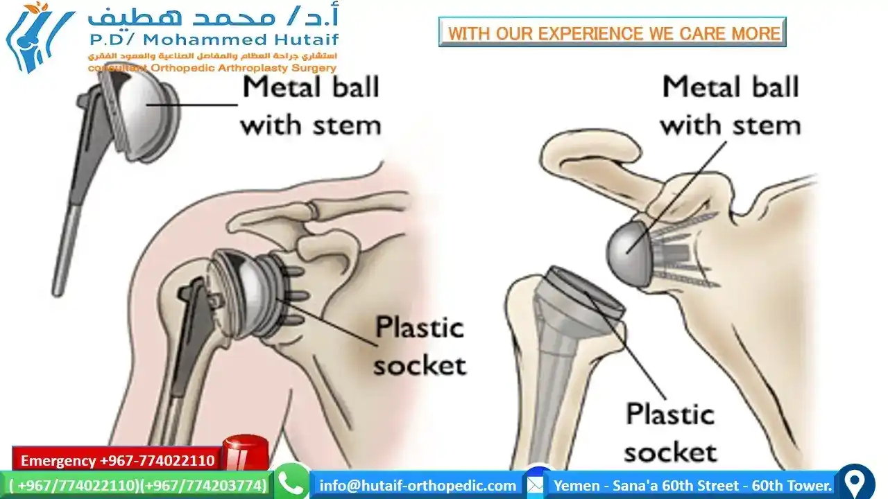 Your risk of developing osteoarthritis of the shoulder with its pain and physical limitations increases with age. But an injury, such as a dislocated shoulder, can lead to shoulder osteoarthritis even in young people. Here is information about the causes of and treatments for shoulder osteoarthritis. Read on to learn how an arthritic shoulder can affect your range of motion and ability to do everyday things, and discover ways to treat and manage the condition.  What Is Osteoarthritis? Osteoarthritis -- also known as degenerative joint disease -- occurs when the cartilage that covers the tops of bones, known as articular cartilage, degenerates or wears down. This causes swelling, pain, and sometimes the development of osteophytes -- bone spurs -- when the ends of the two bones rub together.  What Is Osteoarthritis of the Shoulder? The shoulder is made up of two joints, the acromioclavicular (AC) joint and the glenohumeral joint. The AC joint is the point where the collarbone, or clavicle, meets the acromion, which is the tip of the shoulder blade. The glenohumeral joint is the point where the top of the arm bone, or humerus, meets the shoulder blade, or scapula. Osteoarthritis is more commonly found in the AC joint.   Who Gets Shoulder Osteoarthritis? Osteoarthritis most often occurs in people who are over age 50. In younger people, osteoarthritis can result from an injury or trauma, such as a fractured or dislocated shoulder. This is known as posttraumatic arthritis. Osteoarthritis may also be hereditary.  What Are the Symptoms of Shoulder Osteoarthritis? As with most types of osteoarthritis, pain is a key symptom. A person with shoulder arthritis is likely to have pain while moving the shoulder and after moving the shoulder. The person can even have pain while sleeping.   Another symptom may be a limited range of motion. This limitation can be seen when you are trying to move your arm. It can also be evident if someone is moving your arm to assess range of motion. Moving the shoulder might also produce a clicking or creaking noise.  How Is Shoulder Osteoarthritis Diagnosed? To diagnose shoulder osteoarthritis, the doctor will take a medical history and do a physical exam to assess pain, tenderness, and loss of motion and to look for other signs in surrounding tissues. At this point, the doctor may be able to tell if the muscle near the joint has signs of atrophy, or weakness, from lack of use.  Tests that might be ordered to diagnose osteoarthritis of the shoulder include:  X-rays Blood tests, mainly to look for rheumatoid arthritis, but also to exclude other diseases Removal of synovial fluid, the lubricating fluid in the lining (synovium) of the joint, for analysis MRI scans     How Is Osteoarthritis of the Shoulder Treated? The first treatments for osteoarthritis, including osteoarthritis of the shoulder, do not involve surgery. These treatments include:  Resting the shoulder joint. This could mean that the person with arthritis has to change the way they move the arm while performing the activities of daily living. For example, the person might wear clothing that zips up the front instead of clothing that goes over the head. Or the person might prop up hair dryers instead of holding them up for long periods of time. Taking over-the-counter nonsteroidal anti-inflammatory drugs, such as ibuprofen or aspirin. These drugs, also called NSAIDS, will reduce inflammation and pain. Check with your doctor to make sure you can take these drugs safely. Performing physical therapy as assigned by the doctor. Performing range-of-motion exercises. These exercises are used as an attempt to increase flexibility. Applying moist heat. Applying ice to the shoulder. Ice is applied for 20 minutes two or three times a day to decrease inflammation and pain. Using other medications prescribed by the doctor. These might include injections of corticosteroids, for example. Taking the dietary supplements glucosamine and chondroitin. Many people claim relief with these supplements. Evidence is conflicting as to whether they really help. You should discuss using these with your doctor because the supplements may interact with other drugs. If nonsurgical treatments do not work effectively, there are surgeries available. As with any surgery, there are certain risks and potential complications, including infection or problems with anesthesia. Surgical treatments include:  Shoulder joint replacement (total shoulder arthroplasty). Replacing the whole shoulder with an artificial joint is usually done to treat arthritis of the glenohumeral joint. Replacement of the head of the humerus, or upper arm bone (hemiarthroplasty). This option, too, is used to treat arthritis of the glenohumeral joint. Removal of a small piece of the end of the collarbone (resection arthroplasty). This option is the most common surgery for treating arthritis of the AC joint and associated rotator cuff problems. After the removal of the end of the bone, the space fills with scar tissue.  Show Sources