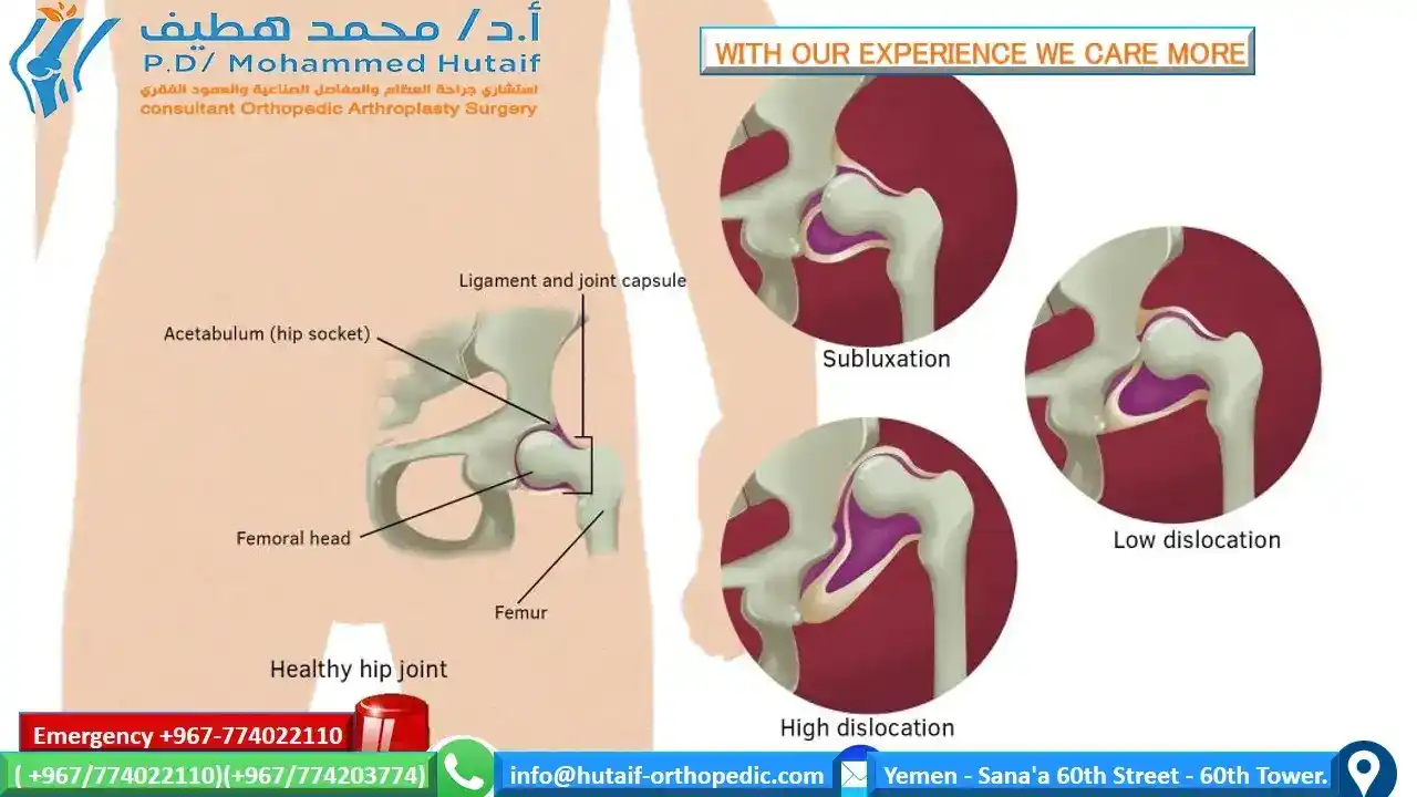  What is the treatment for developmental hip dysplasia? What are the signs of hip dysplasia? Can hip dysplasia be treated? How serious is hip dysplasia in babies?  Developmental dysplasia of the hip بالعربي Developmental dysplasia of the hip radiology Developmental Dysplasia of the hip Physiopedia DDH treatment DDH test DDH surgery DDH wikipedia DDH types  What causes DDH? What is the difference between hip dysplasia and hip dislocation? How is DDH treated? What are the complications of DDH?What is the treatment for developmental hip dysplasia? What are the signs of hip dysplasia? Can hip dysplasia be treated? How serious is hip dysplasia in babies?  Developmental dysplasia of the hip بالعربي Developmental dysplasia of the hip radiology Developmental Dysplasia of the hip Physiopedia DDH treatment DDH test DDH surgery DDH wikipedia DDH types   Developmental dysplasia of the hip بالعربي developmental dysplasia of the hip (ddh) DDH x ray DDH types DDH examination DDH treatment DDH orthobullets DDH wikipedia  DDH wikipedia DDH treatment DDH Radiology DDH diagnosis DDH orthobullets Developmental dysplasia of the hip DDH types Developmental dysplasia of the hip بالعربي