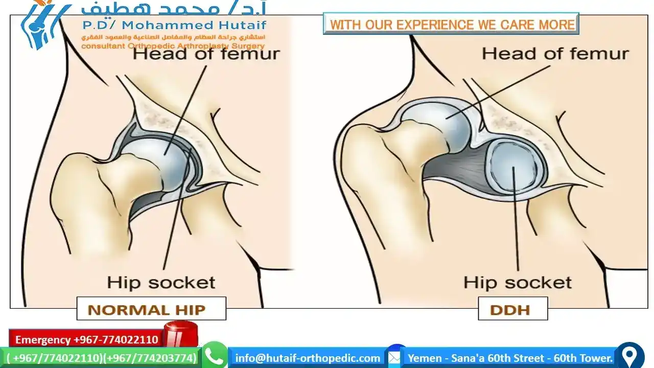 Hip Dysplasia