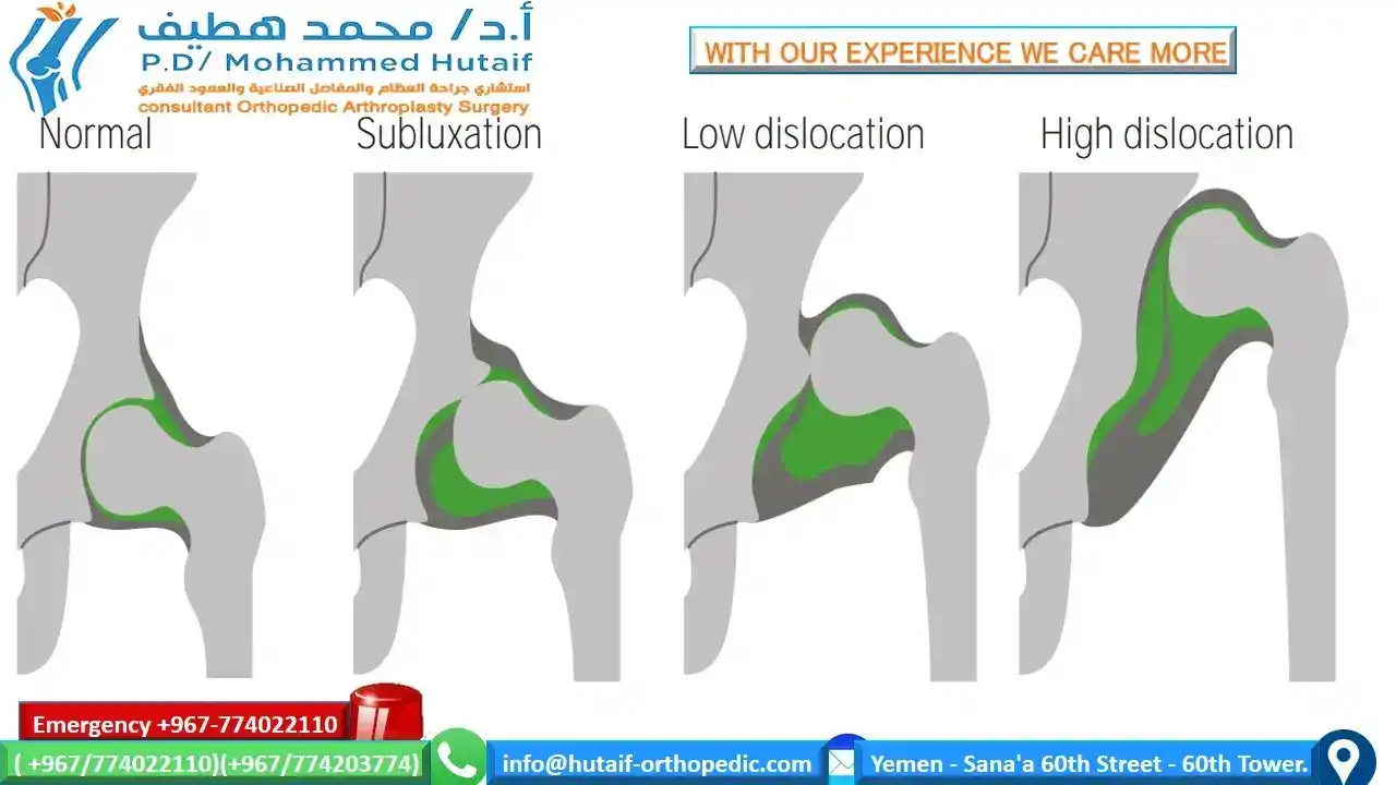  What is the treatment for developmental hip dysplasia? What are the signs of hip dysplasia? Can hip dysplasia be treated? How serious is hip dysplasia in babies?  Developmental dysplasia of the hip بالعربي Developmental dysplasia of the hip radiology Developmental Dysplasia of the hip Physiopedia DDH treatment DDH test DDH surgery DDH wikipedia DDH types  What causes DDH? What is the difference between hip dysplasia and hip dislocation? How is DDH treated? What are the complications of DDH?What is the treatment for developmental hip dysplasia? What are the signs of hip dysplasia? Can hip dysplasia be treated? How serious is hip dysplasia in babies?  Developmental dysplasia of the hip بالعربي Developmental dysplasia of the hip radiology Developmental Dysplasia of the hip Physiopedia DDH treatment DDH test DDH surgery DDH wikipedia DDH types   Developmental dysplasia of the hip بالعربي developmental dysplasia of the hip (ddh) DDH x ray DDH types DDH examination DDH treatment DDH orthobullets DDH wikipedia  DDH wikipedia DDH treatment DDH Radiology DDH diagnosis DDH orthobullets Developmental dysplasia of the hip DDH types Developmental dysplasia of the hip بالعربي