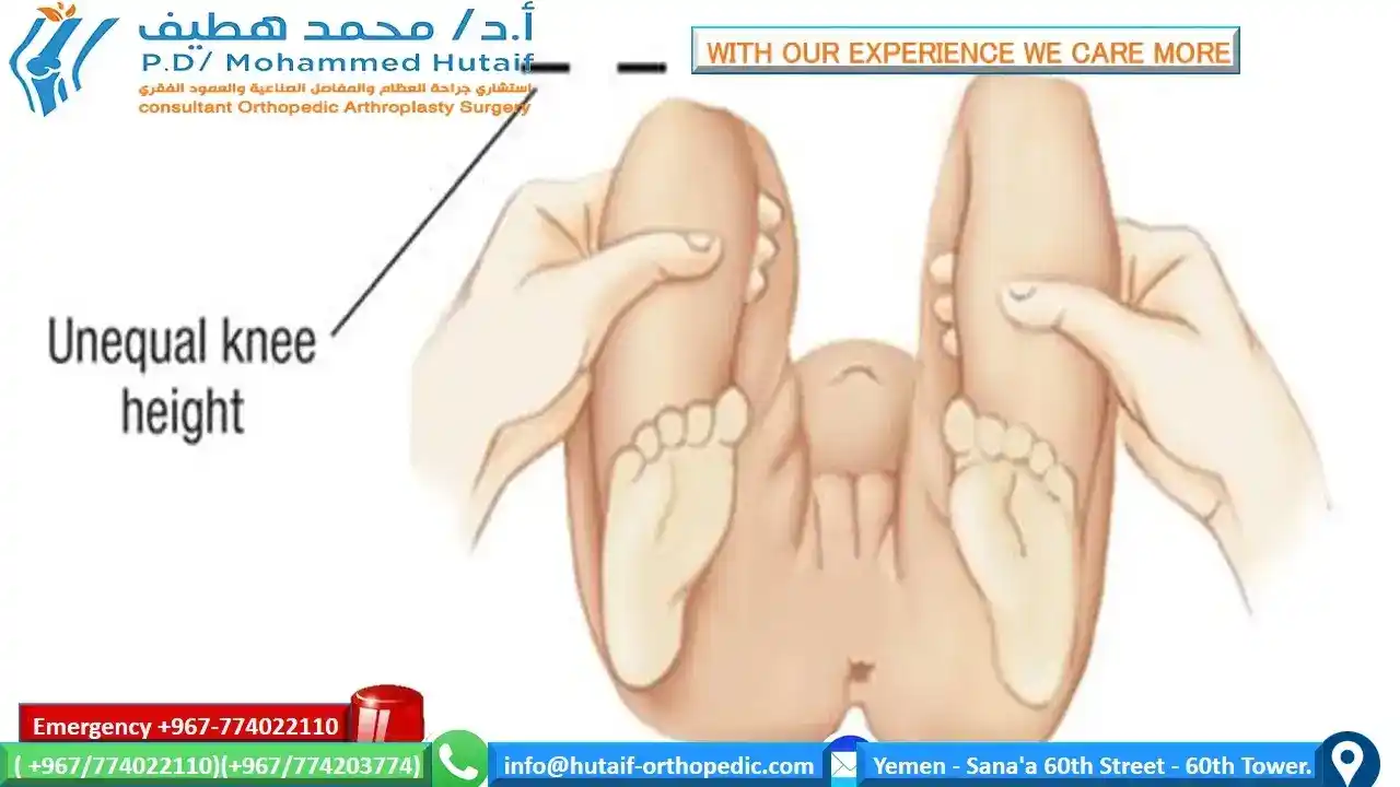 Hip Dysplasia