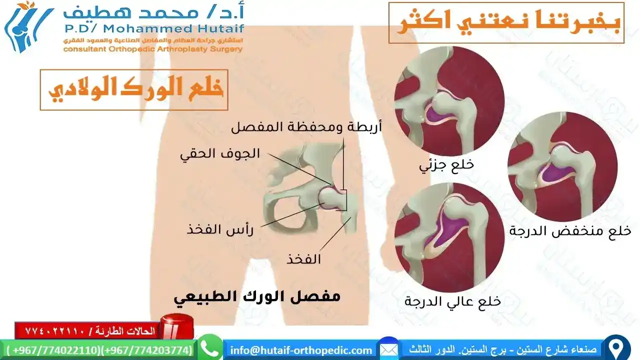 خلع الولادة بالصوردرجات خلع الورك