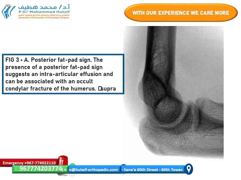 A. Posterior fat-pad sign. The presence of a posterior fat-pad sign suggests an intra-articular effusion and can be associated with an occult supracondylar fracture of the humerus