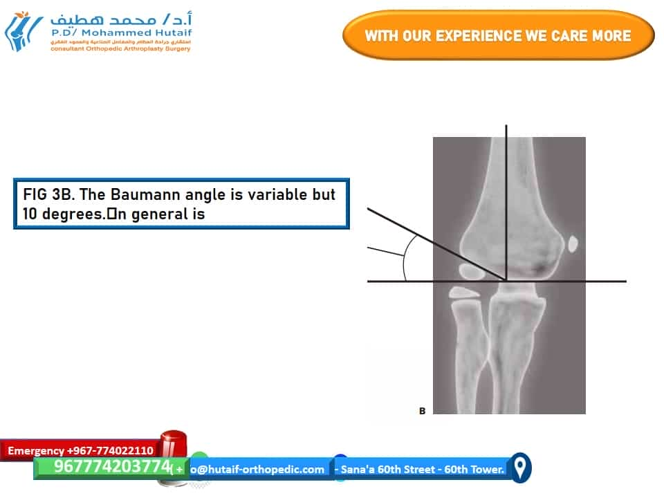 The Baumann angle is variable but in general is 10 degrees. 