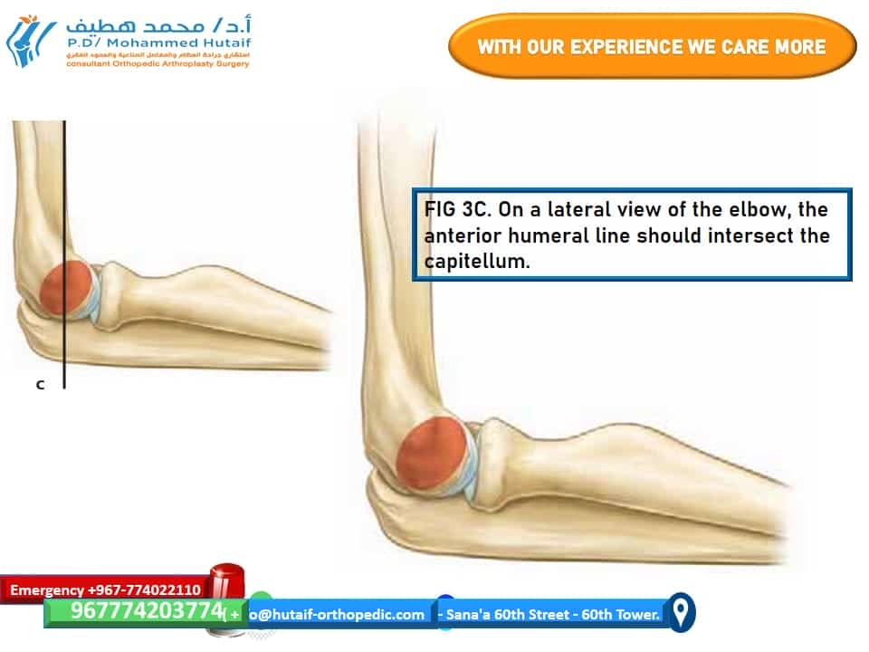 s. C. On a lateral view of the elbow, the anterior humeral line should intersect the capitellum