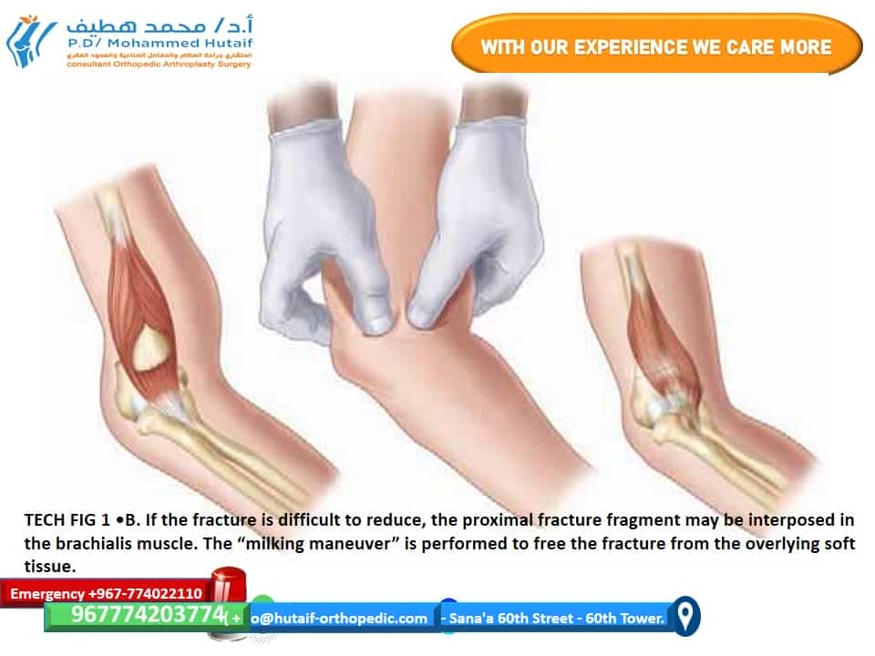 CLOSED REDUCTION Supracondylar Fractures