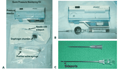 FIG 2 • Stryker intracompartmental pressure monitor. A.  Quick pressure monitoring kit containing the intracompartmental pressure monitor, a prefilled saline syringe, a diaphragm chamber (transducer), and a needle. B. The assembled pressure monitor. To assemble the monitor kit, the needle is attached to the tapered end of the tapered chamber stem (transducer). The blue cap from the prefilled syringe is removed and the syringe is screwed into the remaining end of the transducer, which is a Luer-lock connection. The cover  of the monitor is opened. The transducer is placed inside the well (black  surface down). The snap cover  is closed. Next,  the clear  end cap is pulled off the syringe end, and the monitor is ready to use.  To prime the monitor, the needle is held at 45 degrees up from the horizontal and the syringe plunger is pushed slowly to purge air from the syringe. The monitor is then turned on.  The assembled monitor is tilted at the approximate intended angle of insertion of the needle into the skin. The zero button is pressed to zero the display. The needle is then inserted into the appropriate location in the compartment. C. The intracompartmental pressure monitor needle has side ports to prevent soft  tissue from collapsing around the needle opening.  This is different from a regular needle that has only one opening at the end.