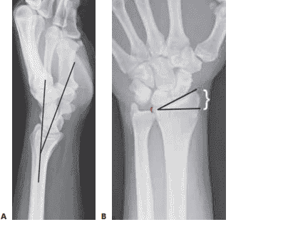 A. Lateral radiograph of the wrist demonstrating volar tilt (black lines). B. PA radiograph demonstrating radial incli- nation (black lines), ulnar variance (red bracket), and radial height (white bracket).