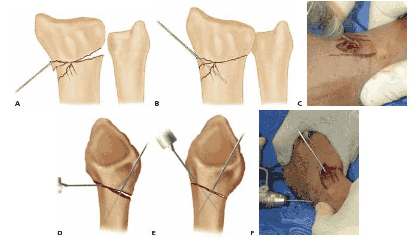 A.  An incision is made over  the radial styloid and a K-wire is manually inserted into the fracture site.  B. The wire is levered distally to correct the radial inclination. C.  The wire  is advanced proximally, using power, into cortical bone. D.  An incision is made over  Lister’s tubercle, and a wire  is inserted into the fracture site.  E,F. The wire  is levered distally to correct the dorsal angulation  and advanced proximally using power into cortical bone.