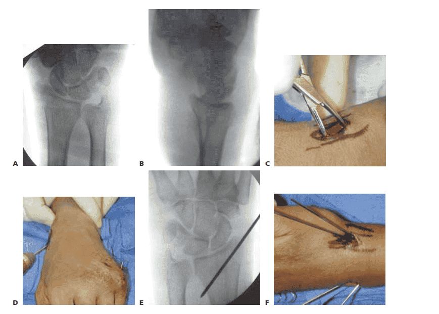 A,B. PA and lateral views demonstrating reduction of distal radius fracture. C.  The incision is made over  the radial styloid. D.  A pin  is inserted retrograde into the radial styloid. E. PA radiograph demonstrating the course of the radial styloid wire. F. Two radial styloid wires  and two dorsoulnar wires  are  in place. (continued)