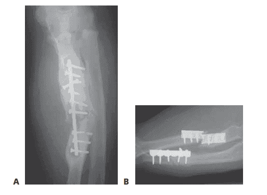 FIG 2 • A.  Radiograph showing an  infected, hypertrophic nonunion. The abundant callus  formation indicates a biologically active nonunion. B. Radiograph showing an atrophic nonunion. There is complete absence of callus  at the fracture site.  The problem in an  atrophic nonunion is lack of biologic activity. (Courtesy of Thomas R. Hunt III, MD.)