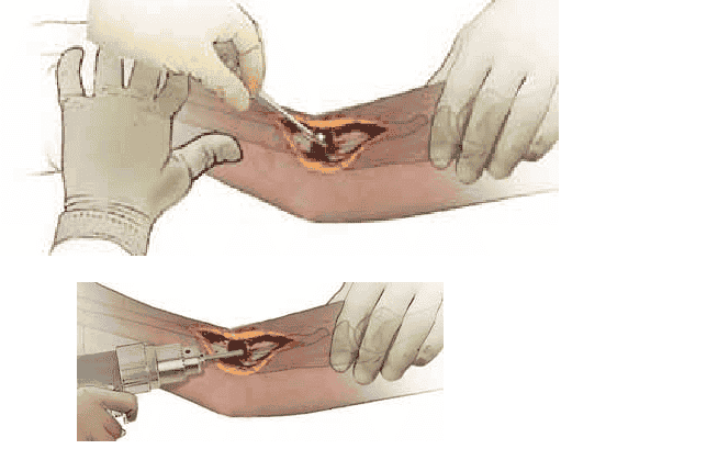 TECH  FIG   1   •   A.    Complete  débridement   of   the nonunion site  is the essential first  step. Any fibrous or necrotic material must be  removed and the bone ends delivered. B.   Medullary canals are   opened  using in creasing-diameter drill bits  to allow vascular ingrowth