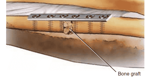 TECH FIG 2  • The  nonunion gap is distracted if necessary to recreate the normal anatomic bone length. A 3.5-mm plate with a minimum of three screws  proximal and distal should be used. Cancellous bone graft  is  inserted and packed in  the nonunion gap.