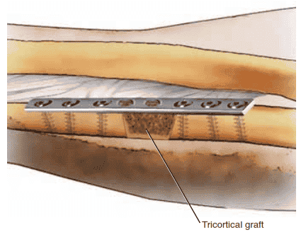 H FIG 4 • Modified Nicoll technique with tricortical iliac crest graft.  The   graft  is   chamfered, allowing the  graft  to  be compressed as the plate is applied.