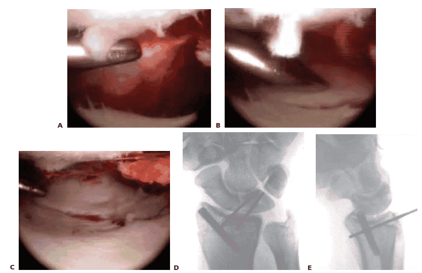 TECH FIG 1 • A.  Arthroscopic view  of the patient whose radiographs are  seen in Figure 1. The arthroscope is in the 6R portal  looking across  the wrist,  and a blunt trochar is in the 3/4 portal. The displaced radial styloid fragment is well  visualized. B.  A combination of  joysticks  inserted into the radial styloid fragment and a  trochar inserted into the 3/4  portal allows anatomic reduction of the displaced radial styloid fragment and radiocarpal joint. C.  The radial styloid fragment is anatomically reduced (with no  residual rotation) and stabilized. D.  PA view  demonstrating anatomic reduction to the radial styloid fragment. Headless cannulated screws  are  used, if possible, to avoid soft  tissue irritation. E.  Lateral view  showing anatomic restoration to the radial styloid fragment and restoration of the carpus in line  with the radiu