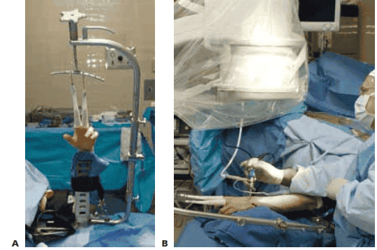 FIG 2 • A.  This traction tower (Acumed, Hillsboro, OR) uses  a suspension bar  at the side  rather than at the center of the wrist.  This allows easy  fluoroscopic  evaluation of the fracture reduction, with simultaneous full access  to the volar  and dorsal aspects of the wrist.  B. The tower can  be  flexed intoa horizontal position for  surgeons who prefer to