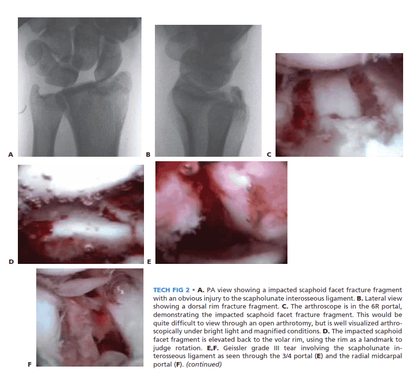 ed scaphoid facet fracture fragment with an obvious injury  to the scapholunate interosseous ligament. B. Lateral view showing a dorsal rim  fracture fragment. C.  The  arthroscope is in the 6R portal, demonstrating the impacted scaphoid facet fracture fragment. This  would be quite difficult to view through an open arthrotomy, but is well visualized arthroscopically under bright light and magnified conditions. D. The impacted scaphoid facet fragment is elevated back  to the volar  rim,  using the rim as a landmark to judge  rotation.  E,F.  Geissler   grade  III   tear  involving the  scapholunate  interosseous ligament as seen through the 3/4 portal (E) and the radial midcarpal