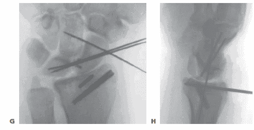 TECH FIG 2 • (continued) G,H. PA and lateral radiographs showing anatomic reduction to the impacted scaphoid facet fracture. (The  tear of the scapholunate interosseou