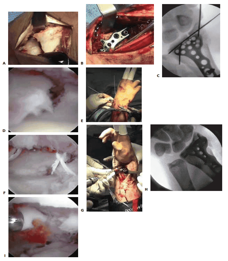 TECH FIG 4 • A.  A standard volar  approach is made, centered over  the flexor carpi  radialis tendon, and the fracture site  is exposed. B.  A volar  distal radius locking plate  (Acumed, Hillsboro, OR) is applied. The  initial screw  is placed through the proximal plate to secure the plate to the shaft. C. The intra-articular reduction is viewed under fluoroscopy and provisionally pinned. A displaced intra-articular fracture fragment can  still be  identified. D.  The arthroscope is in the 3/4 portal, showing the volar  capsule blocking reduction of the radial styloid fragment. E.  Joysticks  previously inserted into the radial styloid fragment are  then used to control and anatomically reduce the radial styloid fragment. F. The arthroscope is in the 6R portal looking across  the wrist.  Anatomic reduction of the radial styloid fragment is documented. G.  Once  the anatomic restoration of the articular surface is evaluated both arthroscopically and fluoroscopically, the distal screws  are  placed in the plate. H. Fluoroscopic view  showing anatomic restoration to the articular surface  of the distal radius. I. The patient had an  associated osteochondral fracture of the lunate, not visible  on  plain radiographs. The displaced fragment is arthroscopically removed.