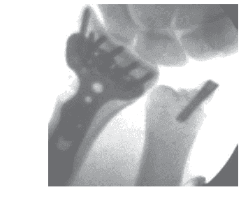 Arthroscopic-Assisted Reduction of Distal Radius Fractures