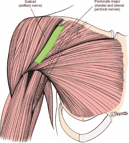 Figure 1-8 The internervous plane lies between the deltoid muscle (axillary nerve)