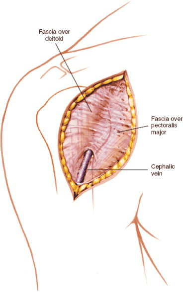 Figure 1-9 Develop the groove between the fascia overlying the pectoralis major and the fascia overlying the deltoid. The cephalic vein will be of help in locating the groove.