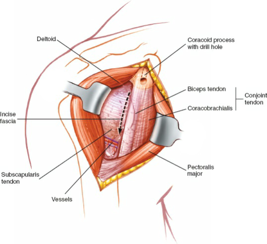 0 Retract the pectoralis major medially and the deltoid laterally to expose the conjoined tendon of the short head of the biceps and coracobrachialis muscle. Drill the tip of the coracoid process before cutting it. Incise the fascia on the lateral aspect of the conjoint tendon. Note the leash of vessels at the inferior end of the subscapularis muscle.
