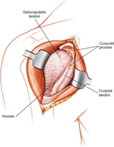 Figure 1-11 Cut through the predrilled coracoid process. Retract  the conjoint