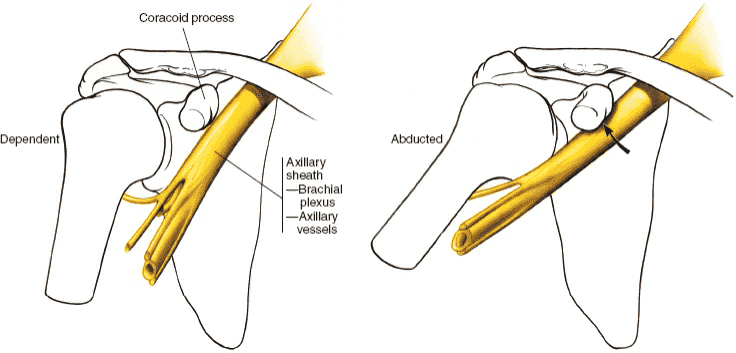 Figure 1-12 Protect the axillary sheath during coracoid osteotomy by having the arm in the dependent position; abduction of the arm will draw the sheath against the coracoid process.