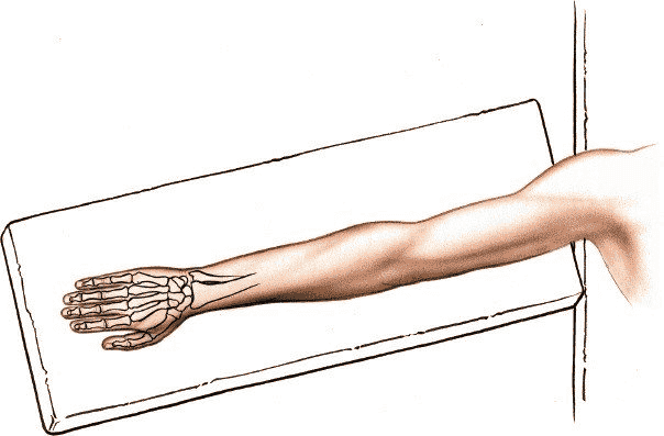 Figure 5-1 Place the patient supine on the operating table. Turn the forearm downward and place the arm on a board, for the dorsal approach to the wrist joint.